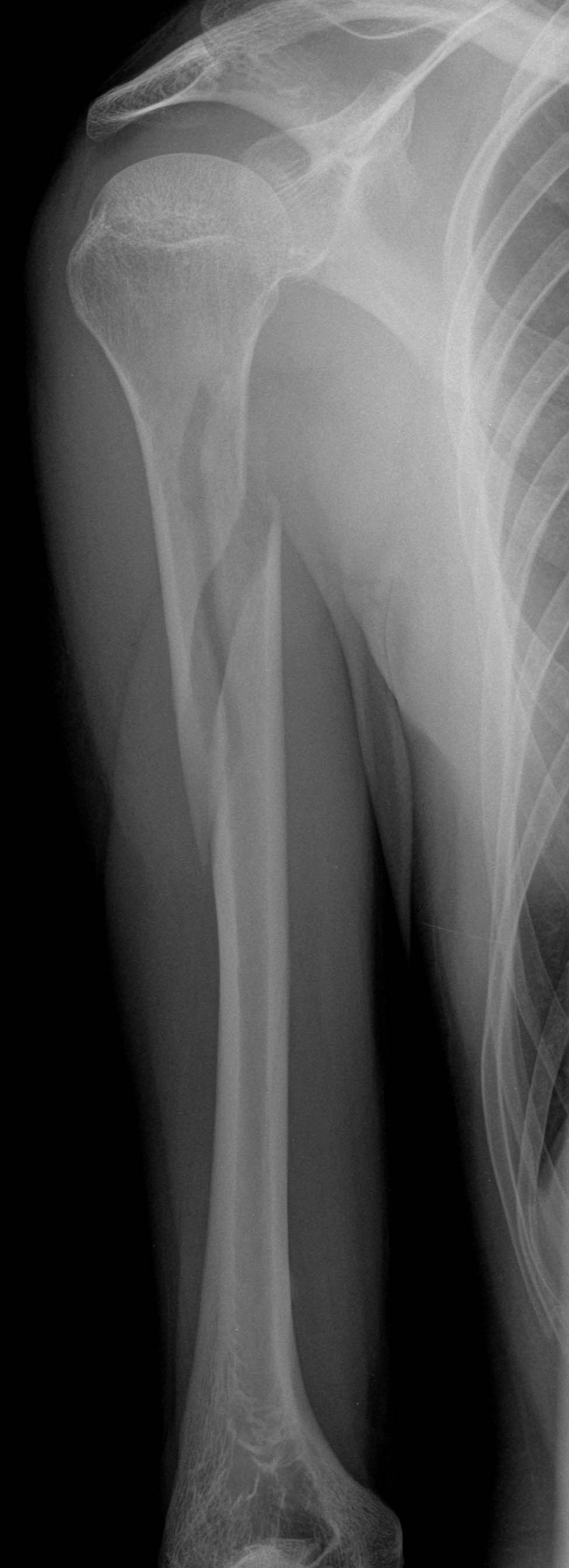 | AP humerus
