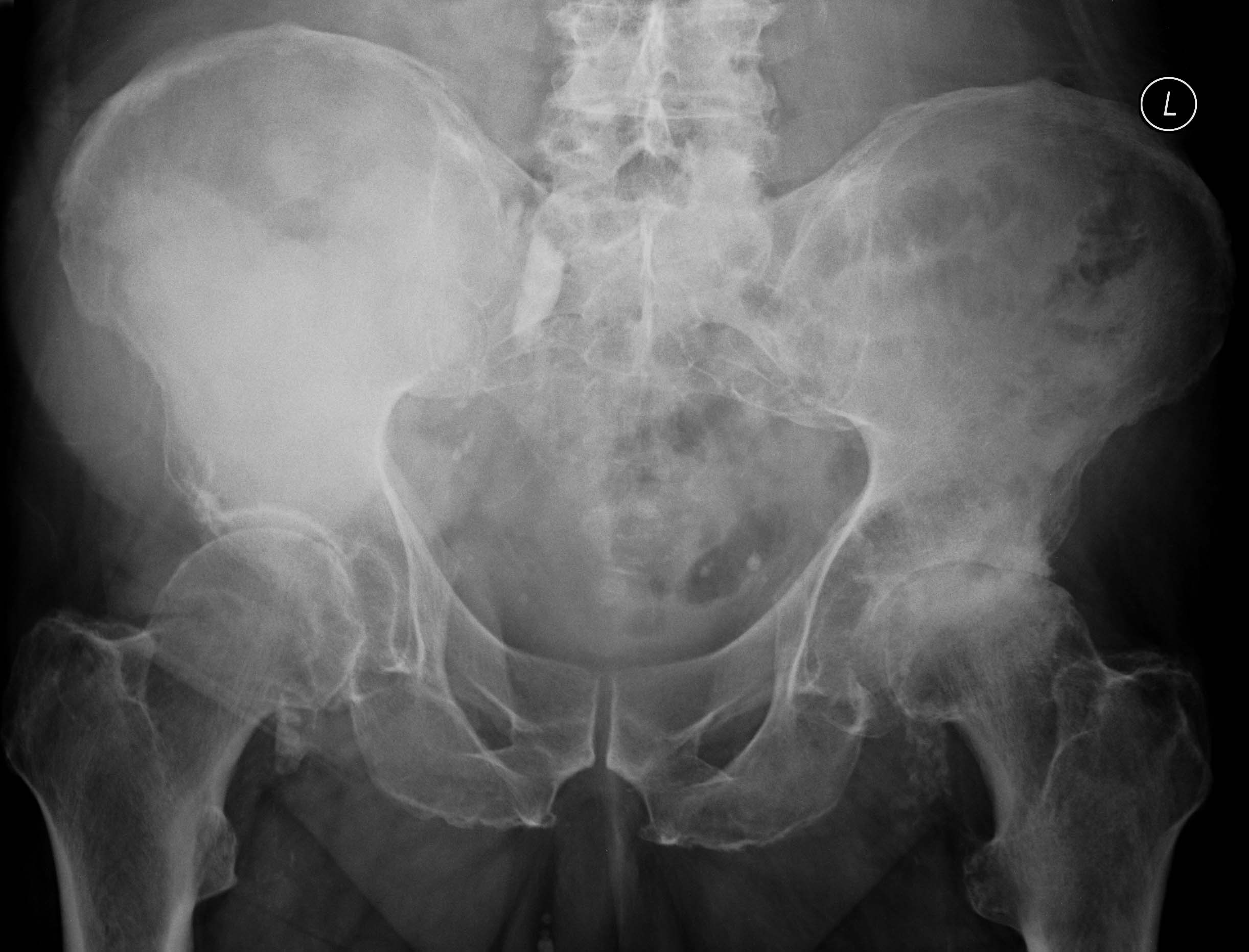 | AP pelvis