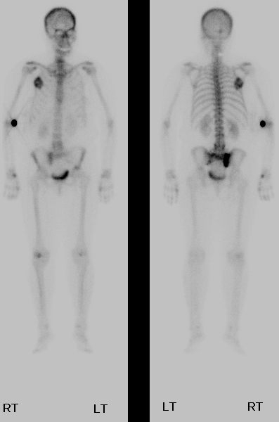 | Whole body bone scintigraphy