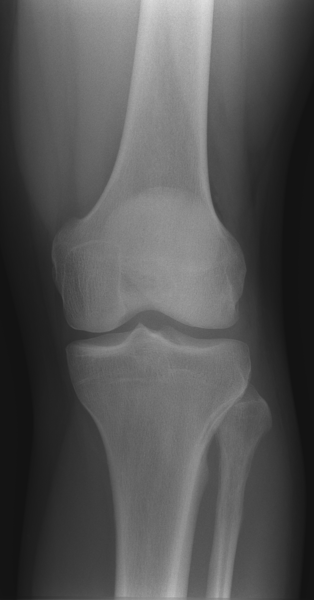 | AP knee