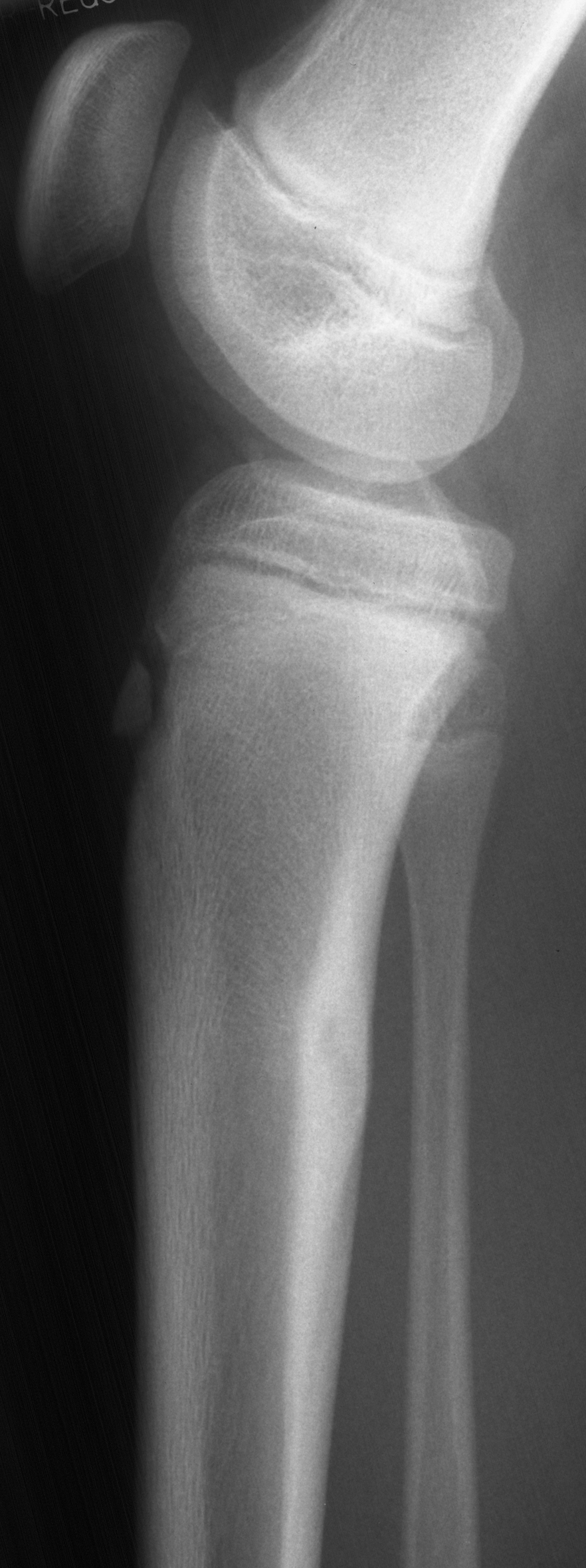 1. Lateral tibia