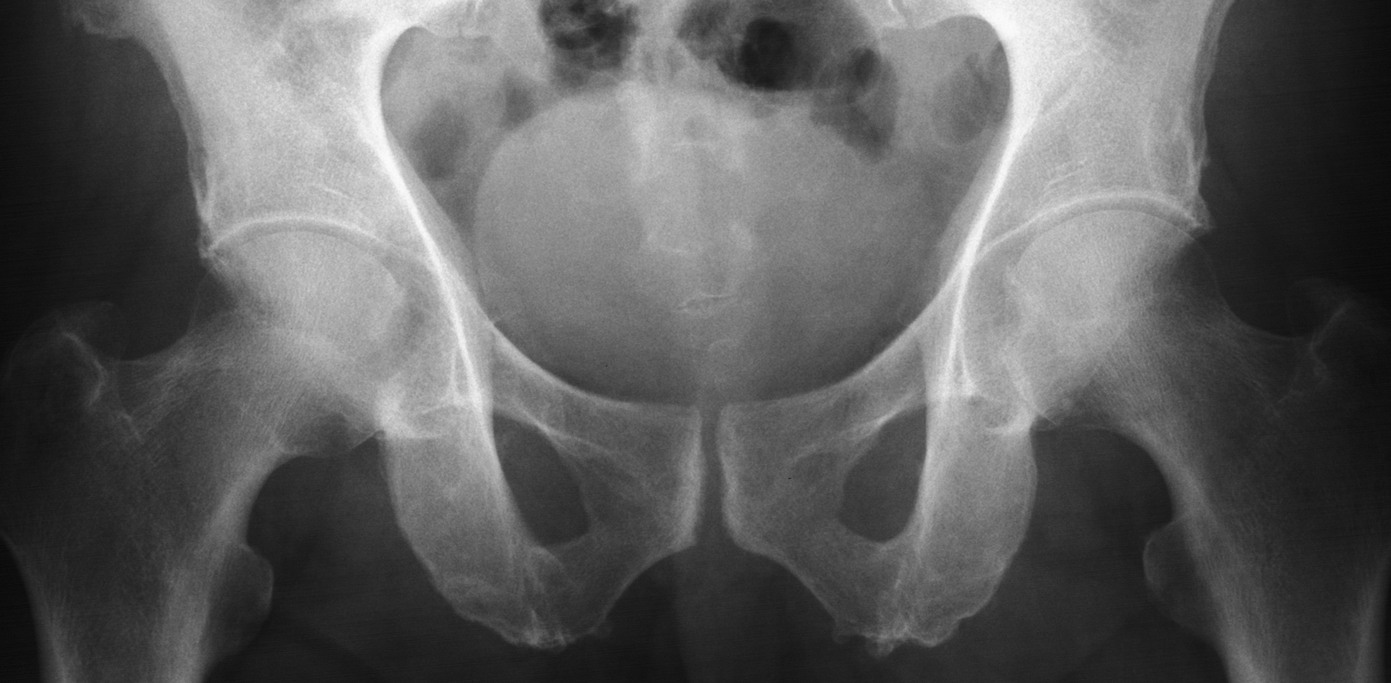1. AP hips