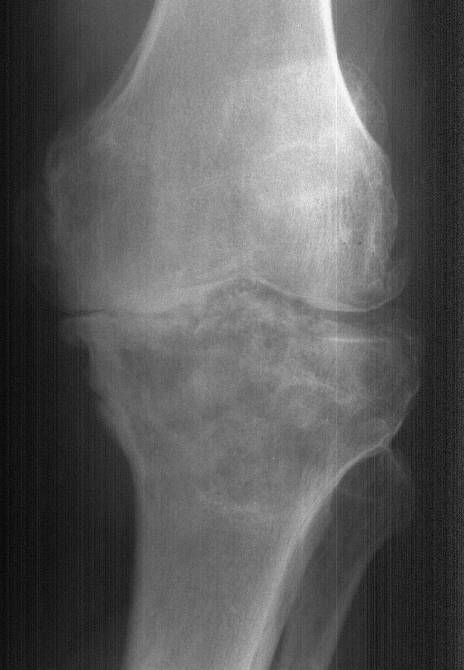 1. AP knee