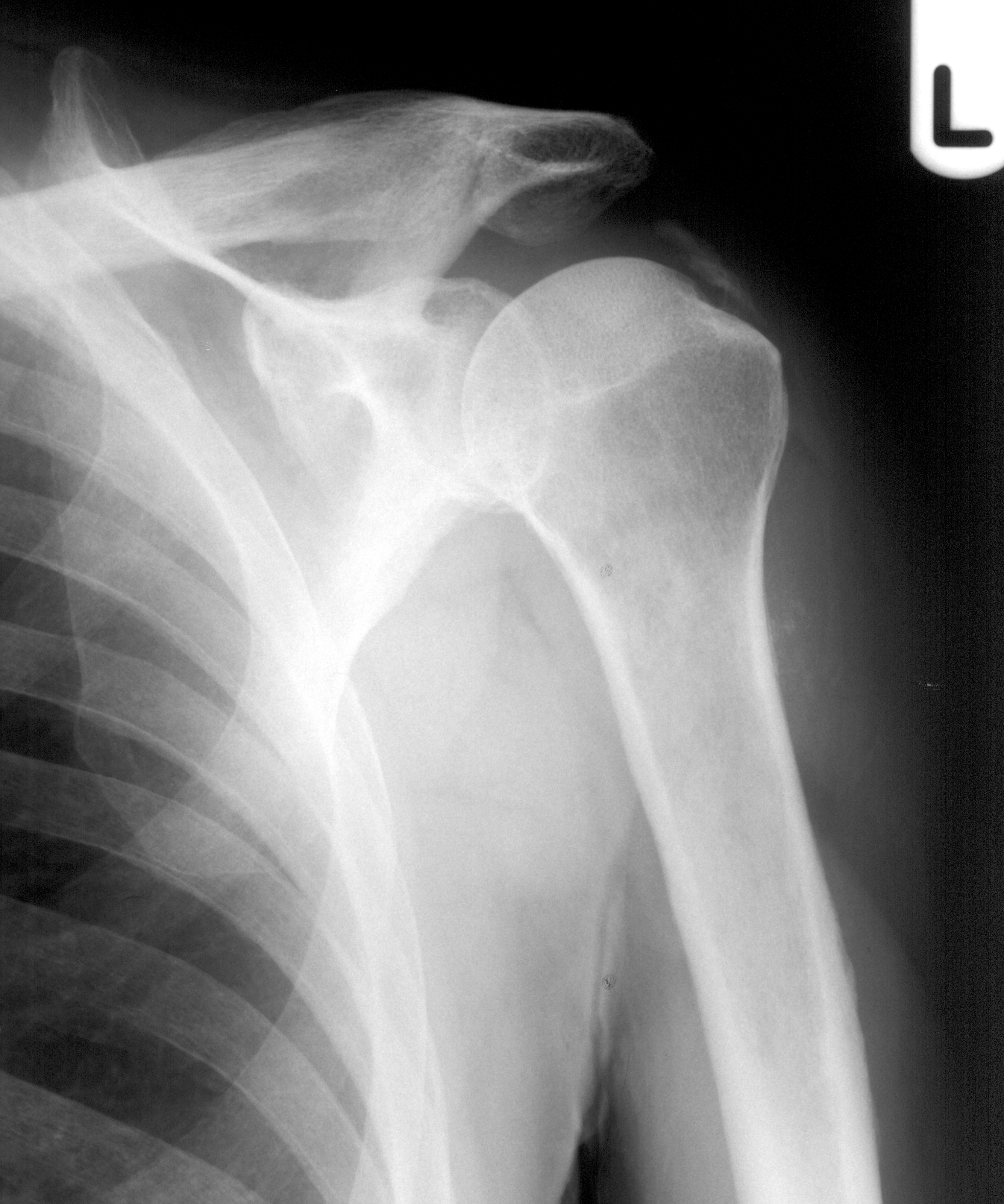 1. AP shoulder
