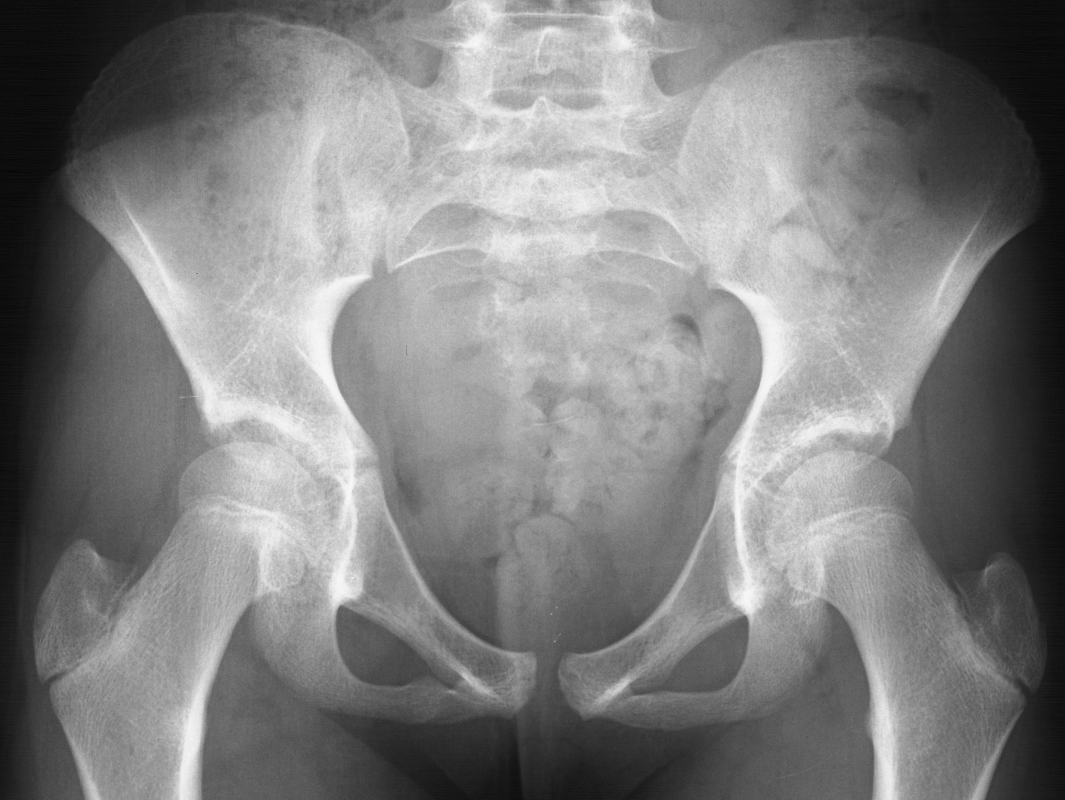 1. AP pelvis