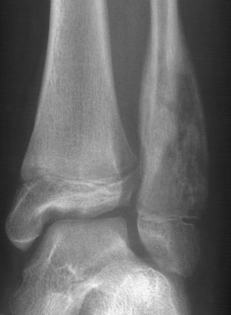 1. AP ankle