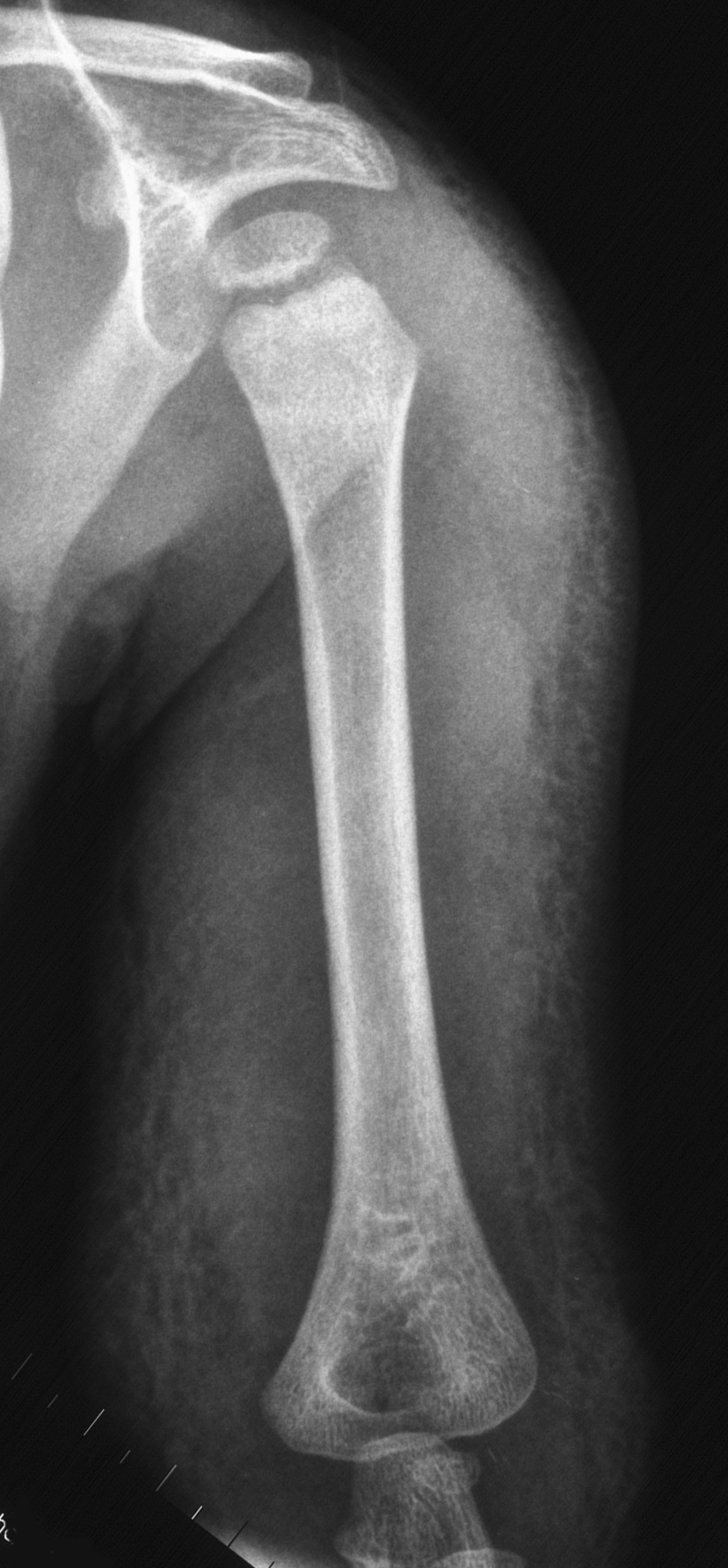 1. AP humerus