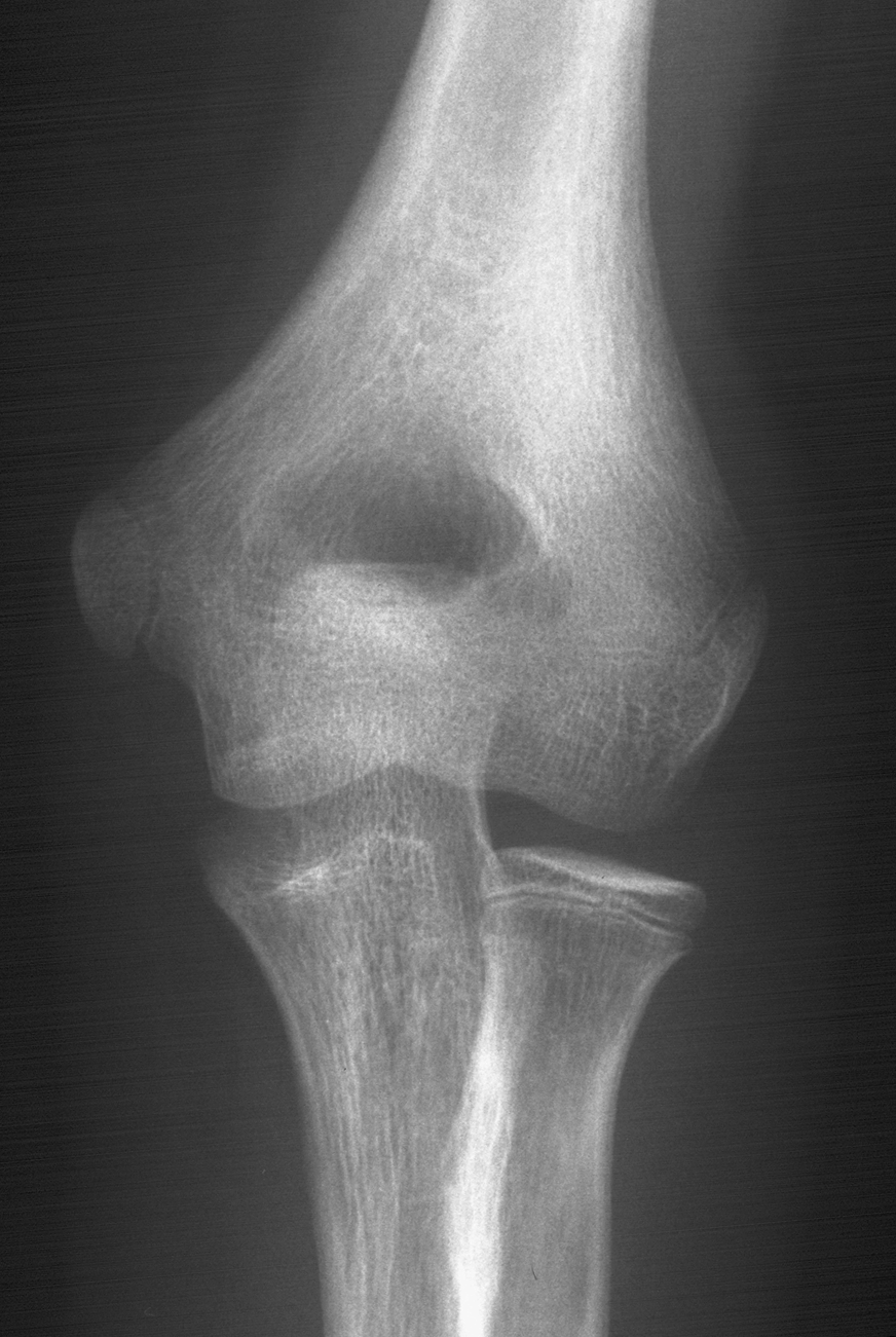 1. AP elbow