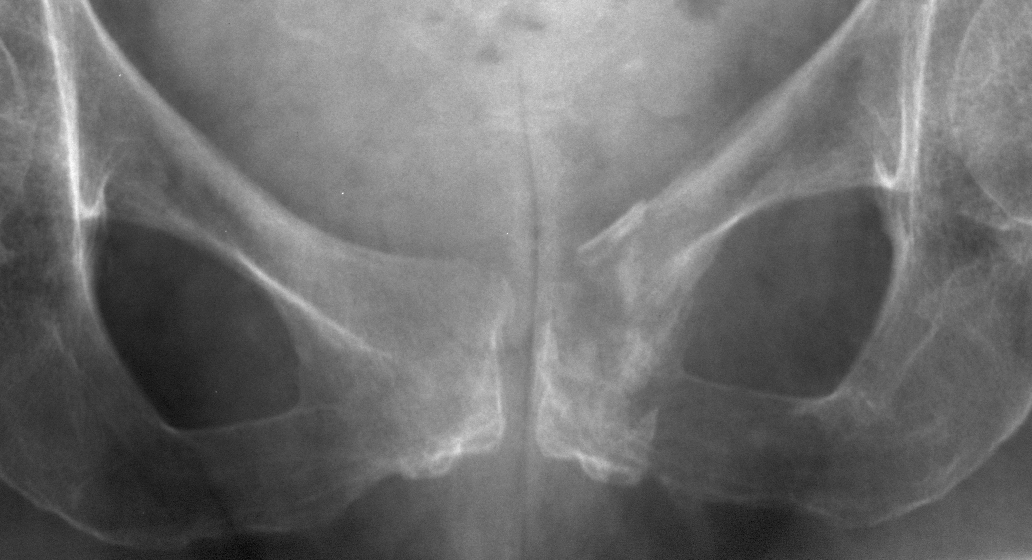 1. AP pubis