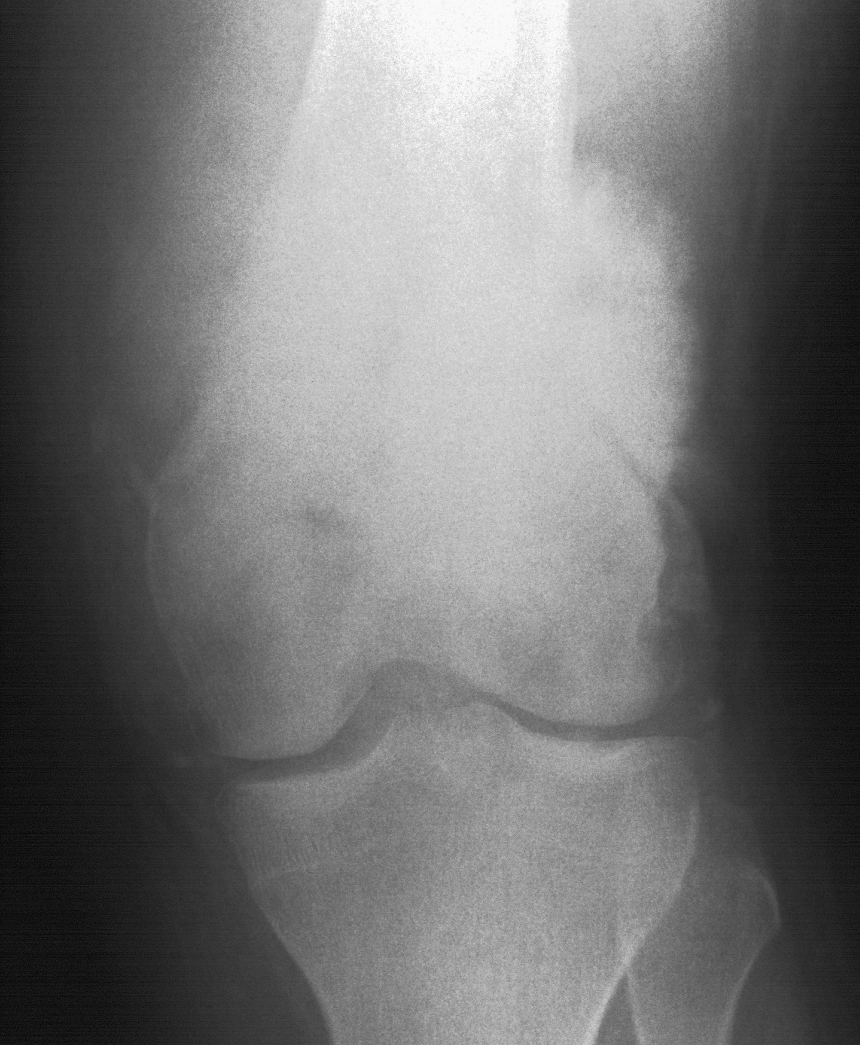1. AP knee
