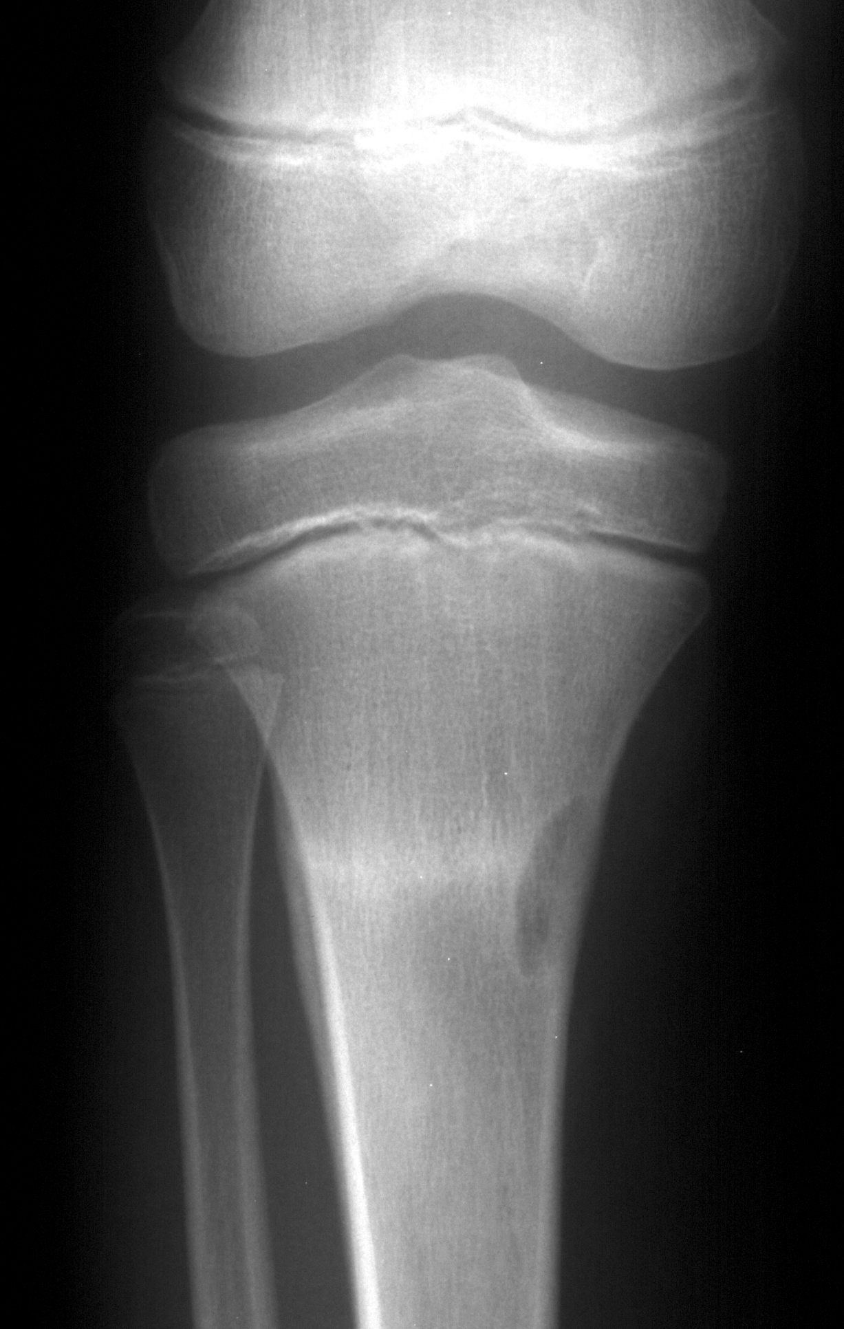 1. AP knee