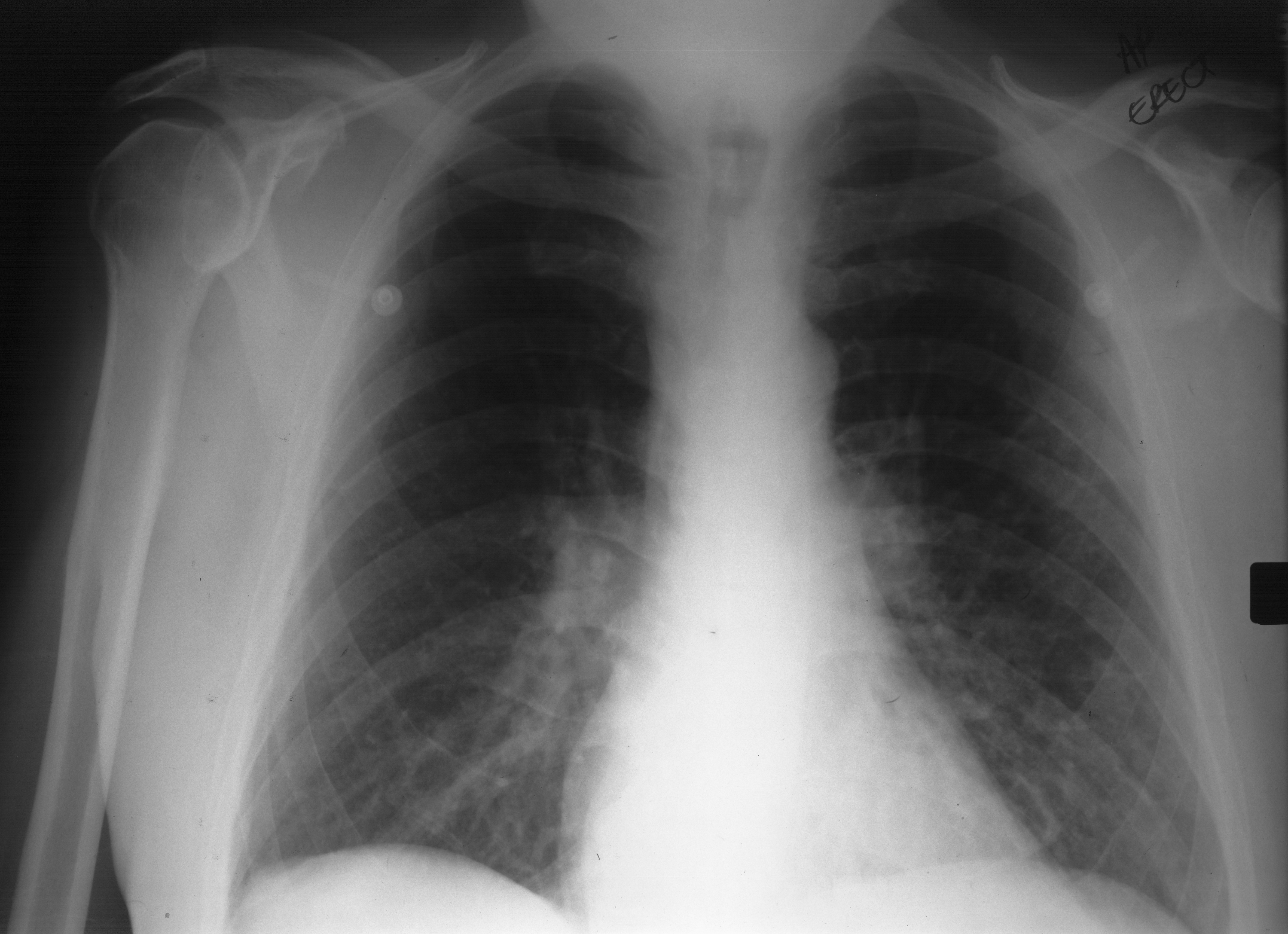 1. PA chest