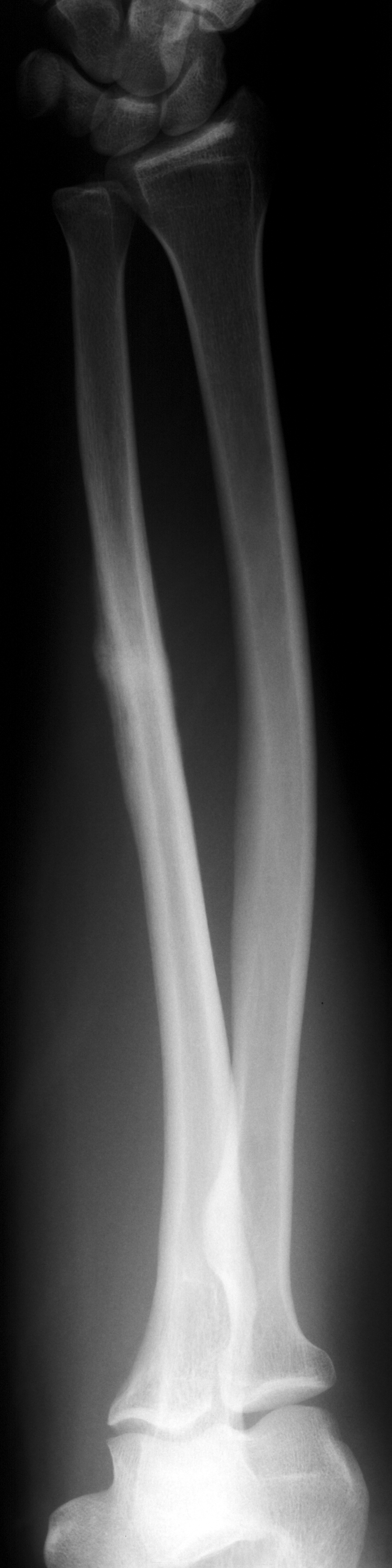 1. PA forearm