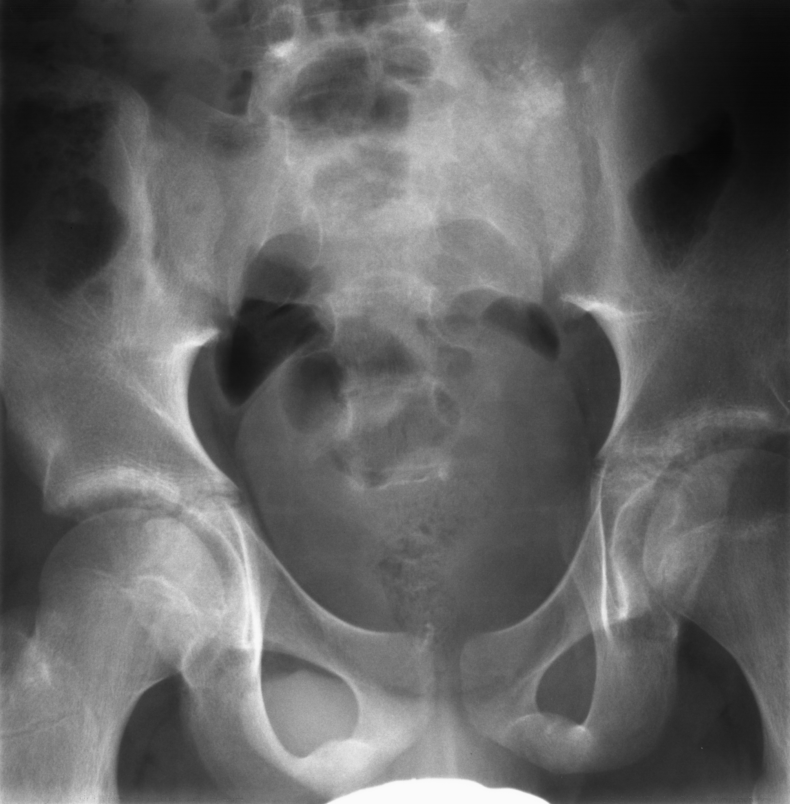 1. AP sacrum