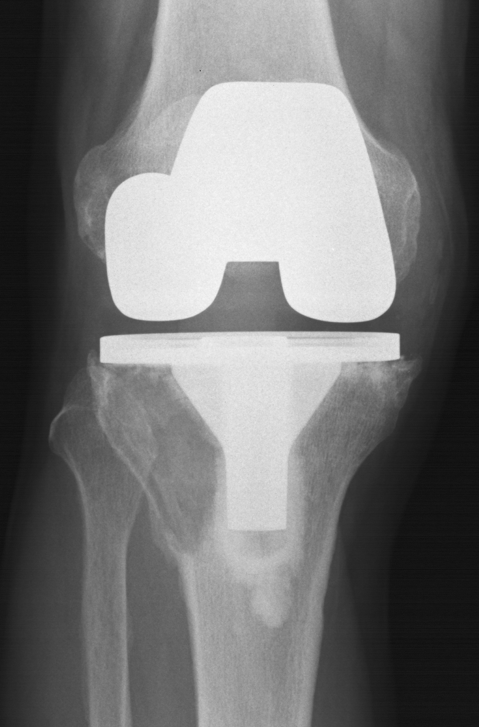 1. AP knee