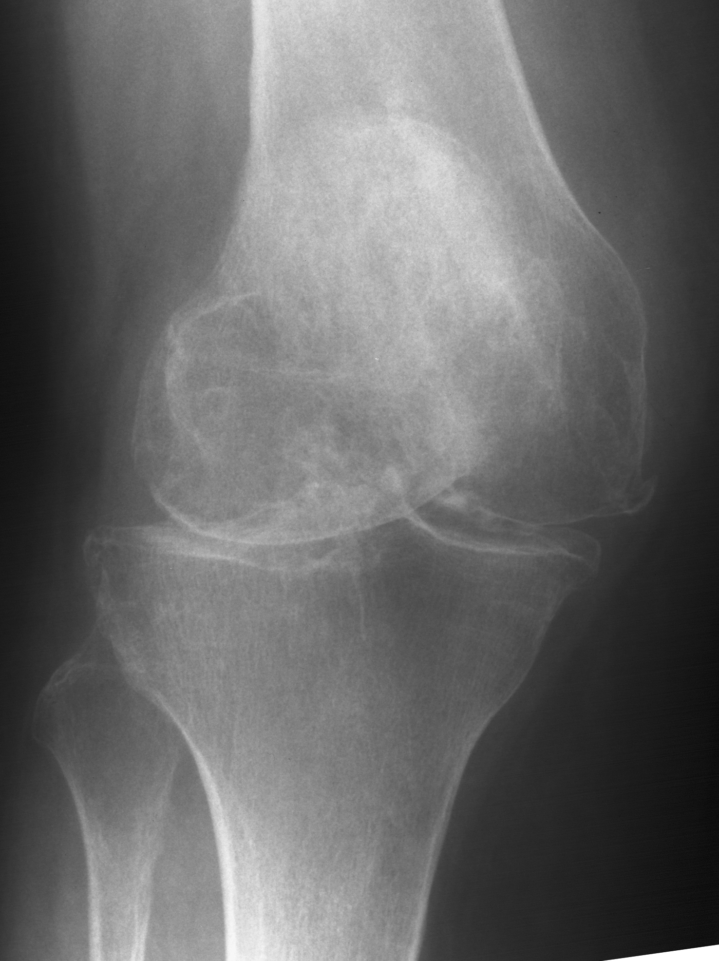 1. AP knee