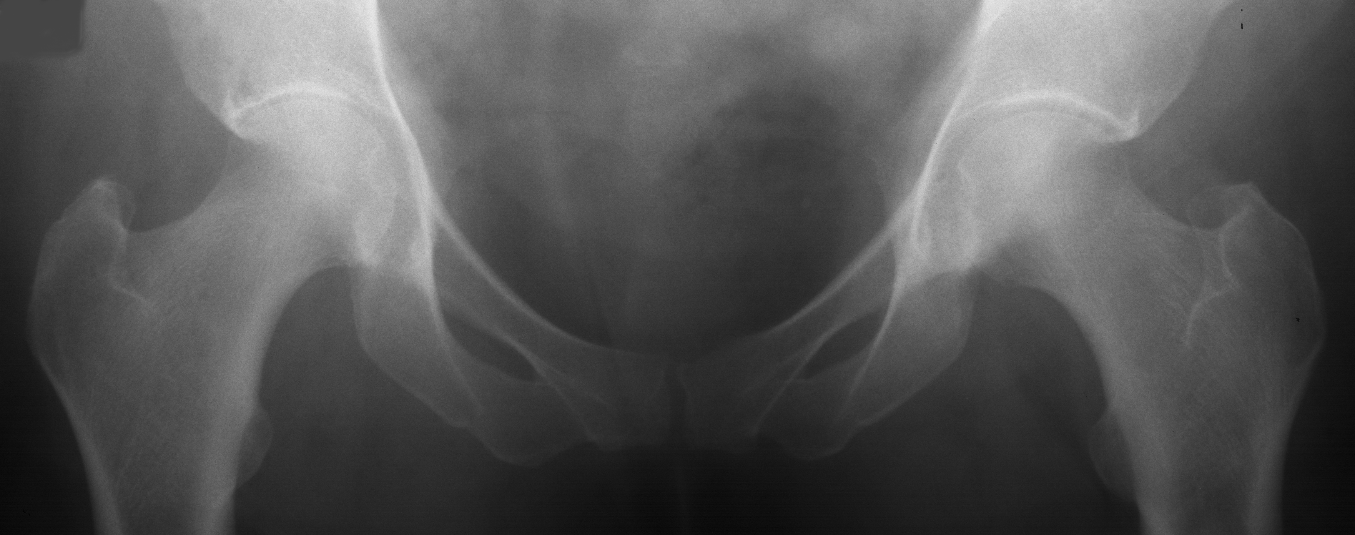 1. AP hips