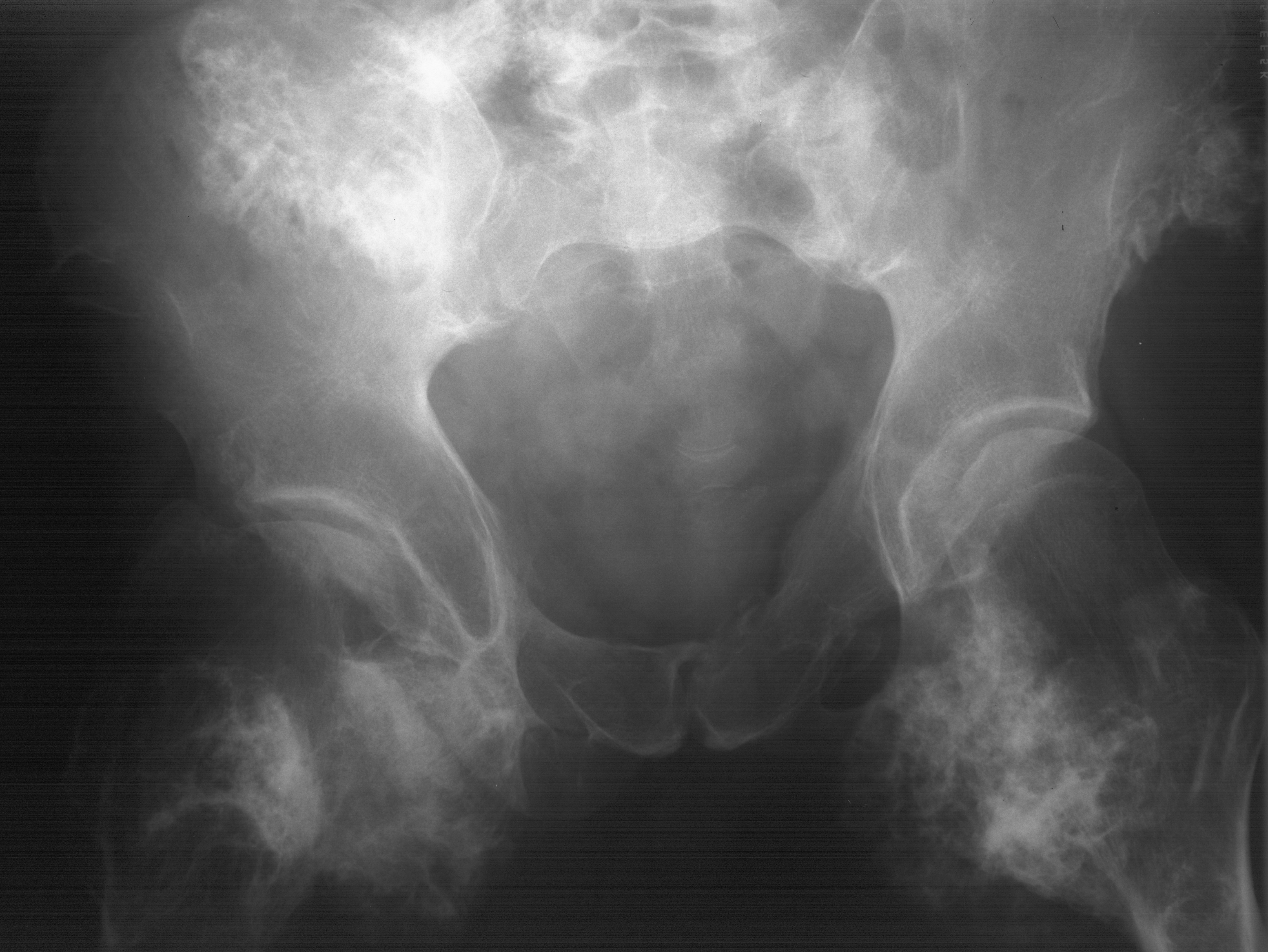 1. AP pelvis