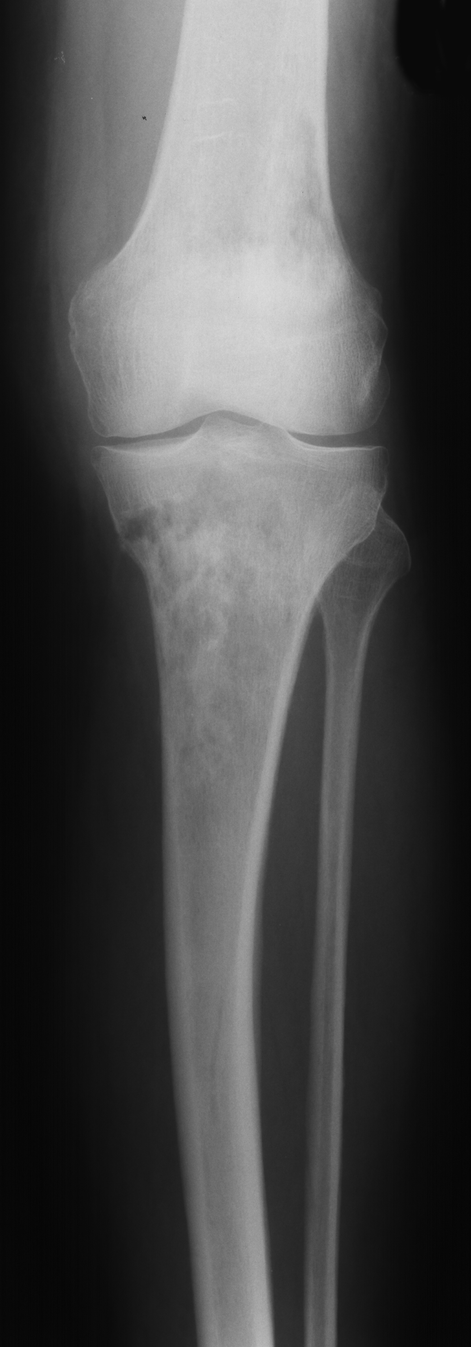 1. AP knee