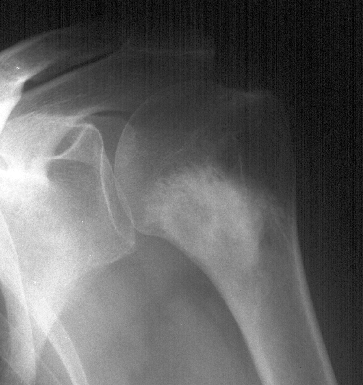 1. AP shoulder