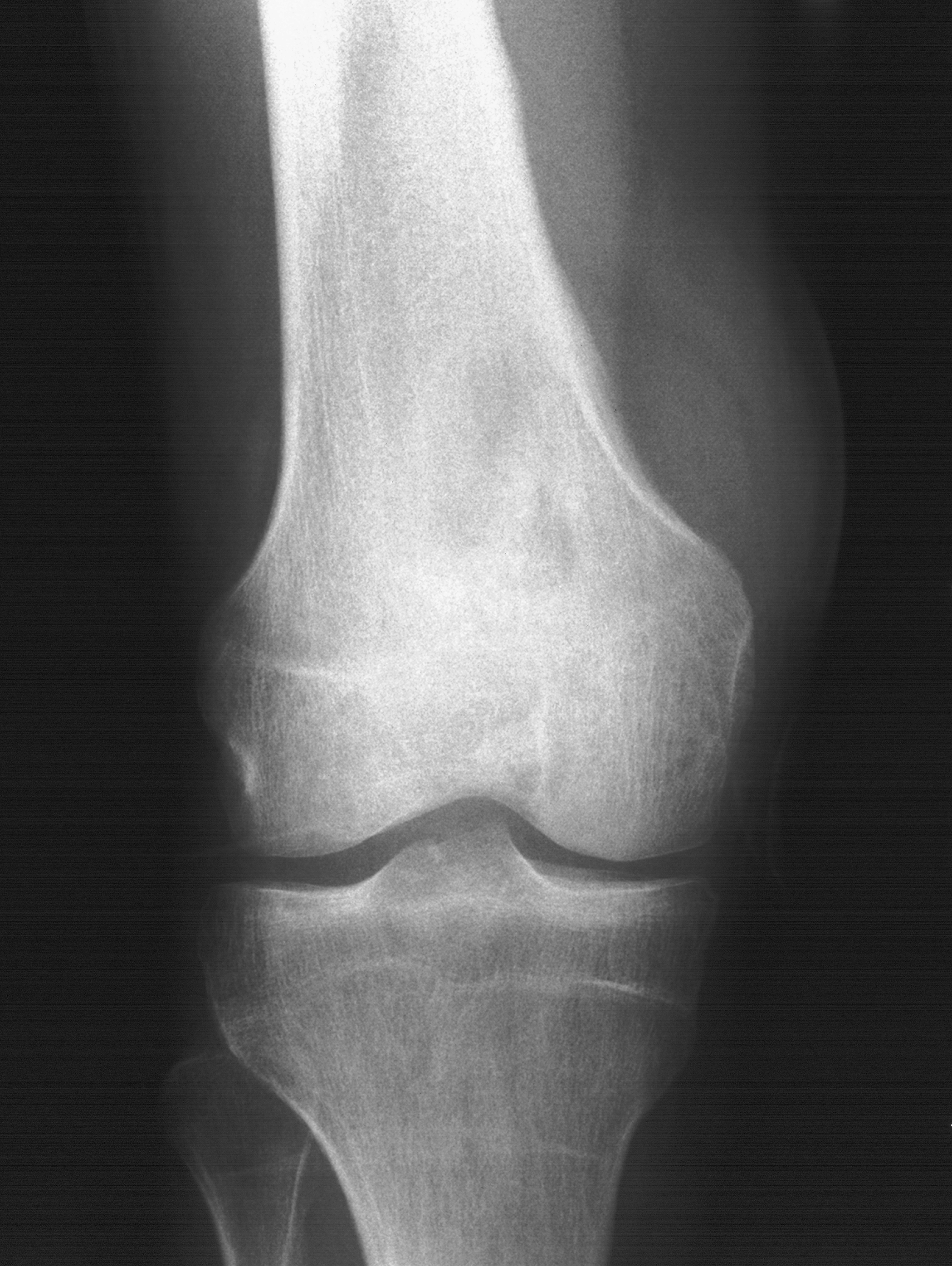 1. AP knee
