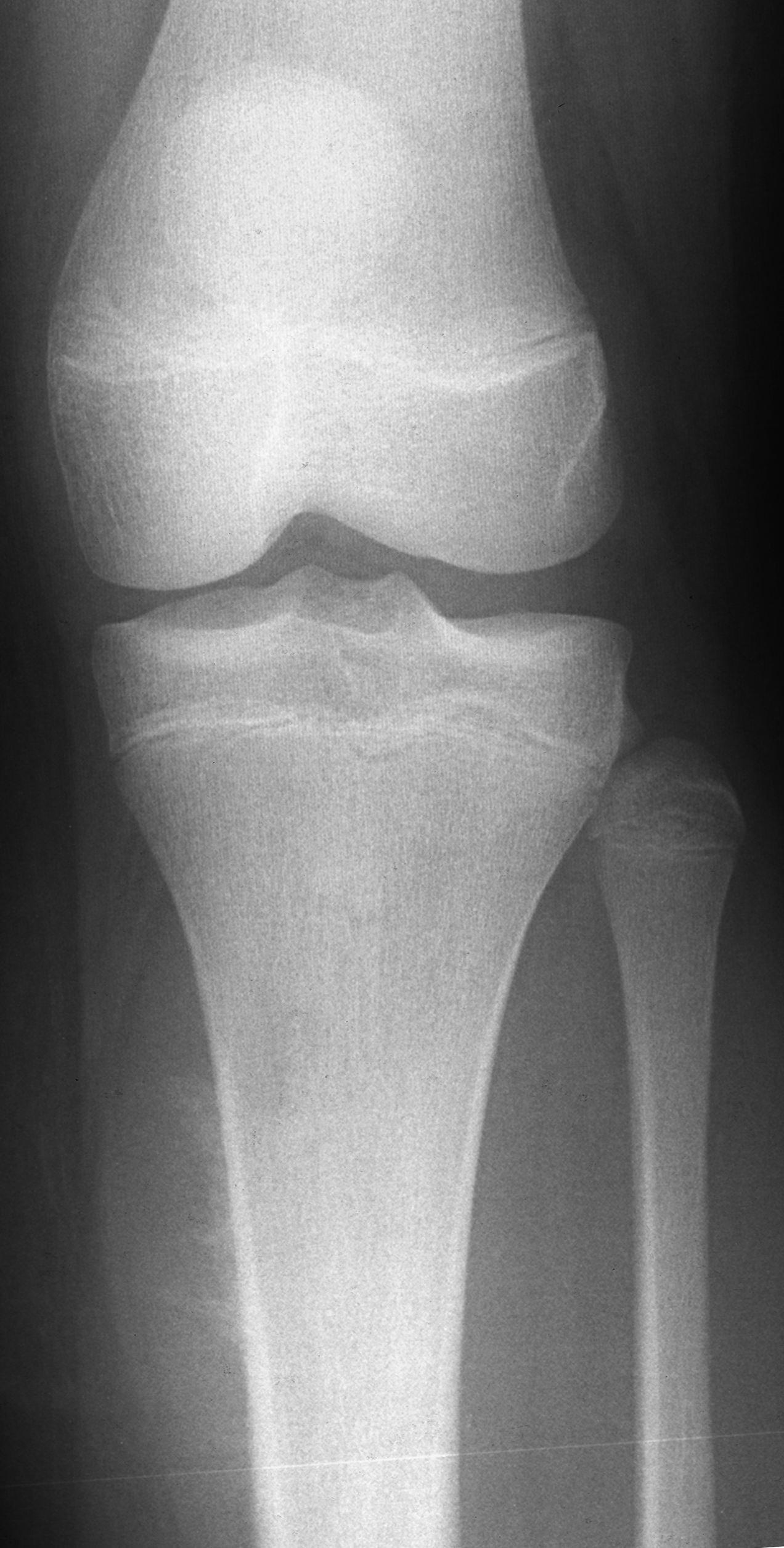 1. AP tibia