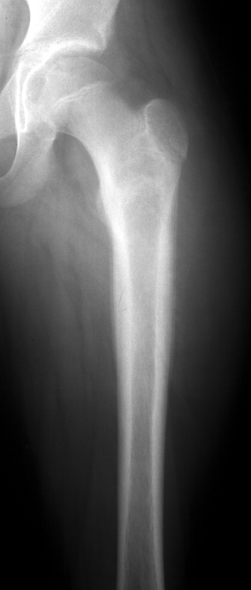 1. AP femur