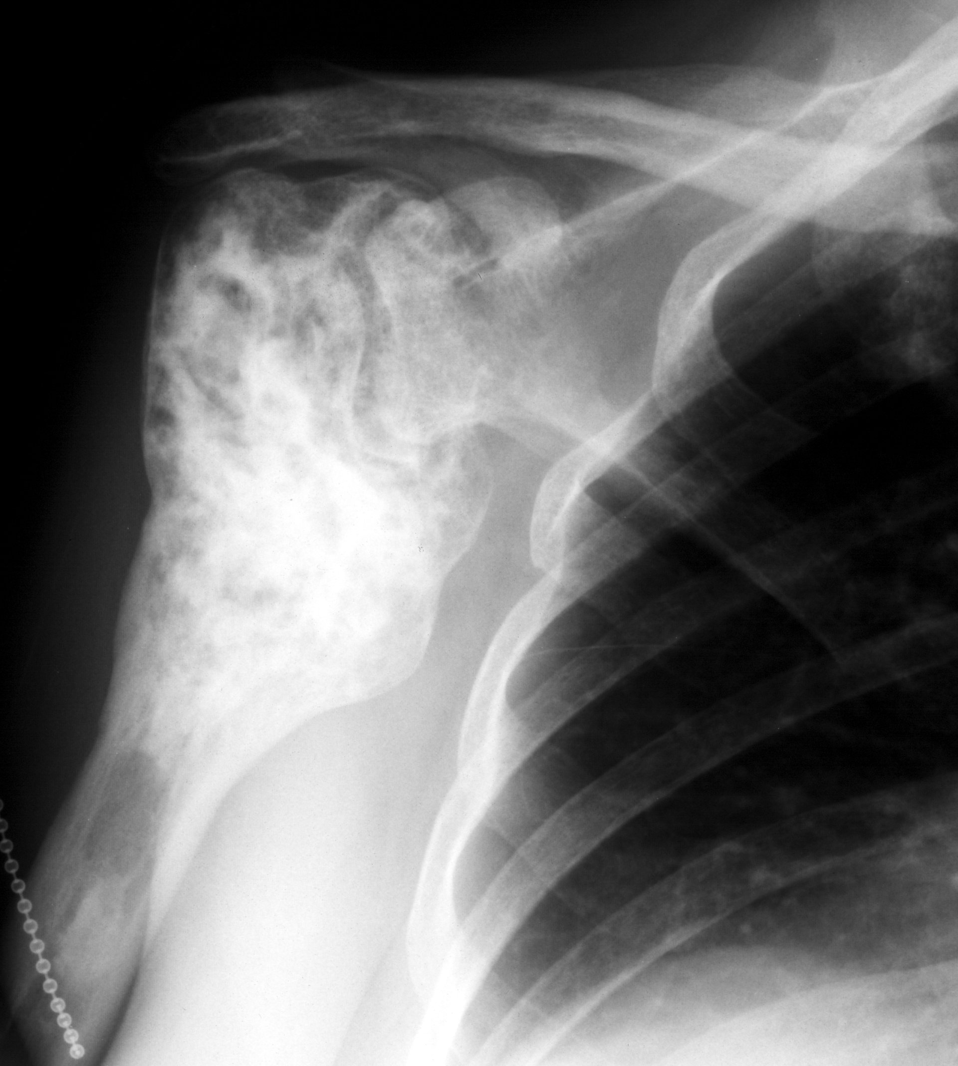 1. AP shoulder