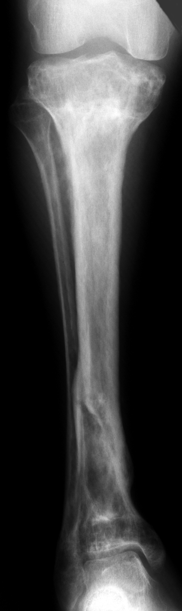 1. AP tibia