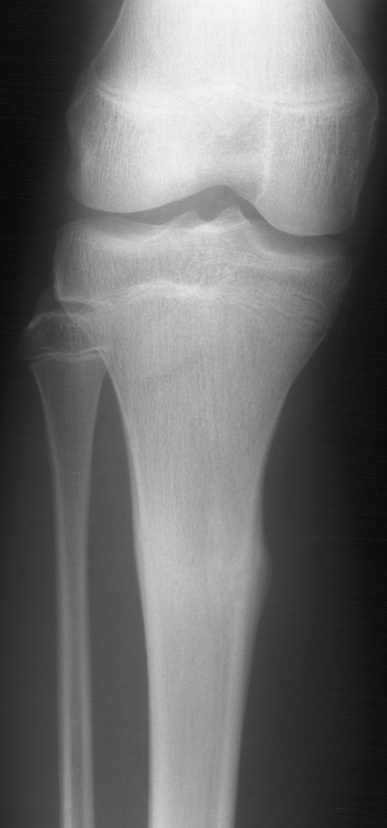 1. AP tibia