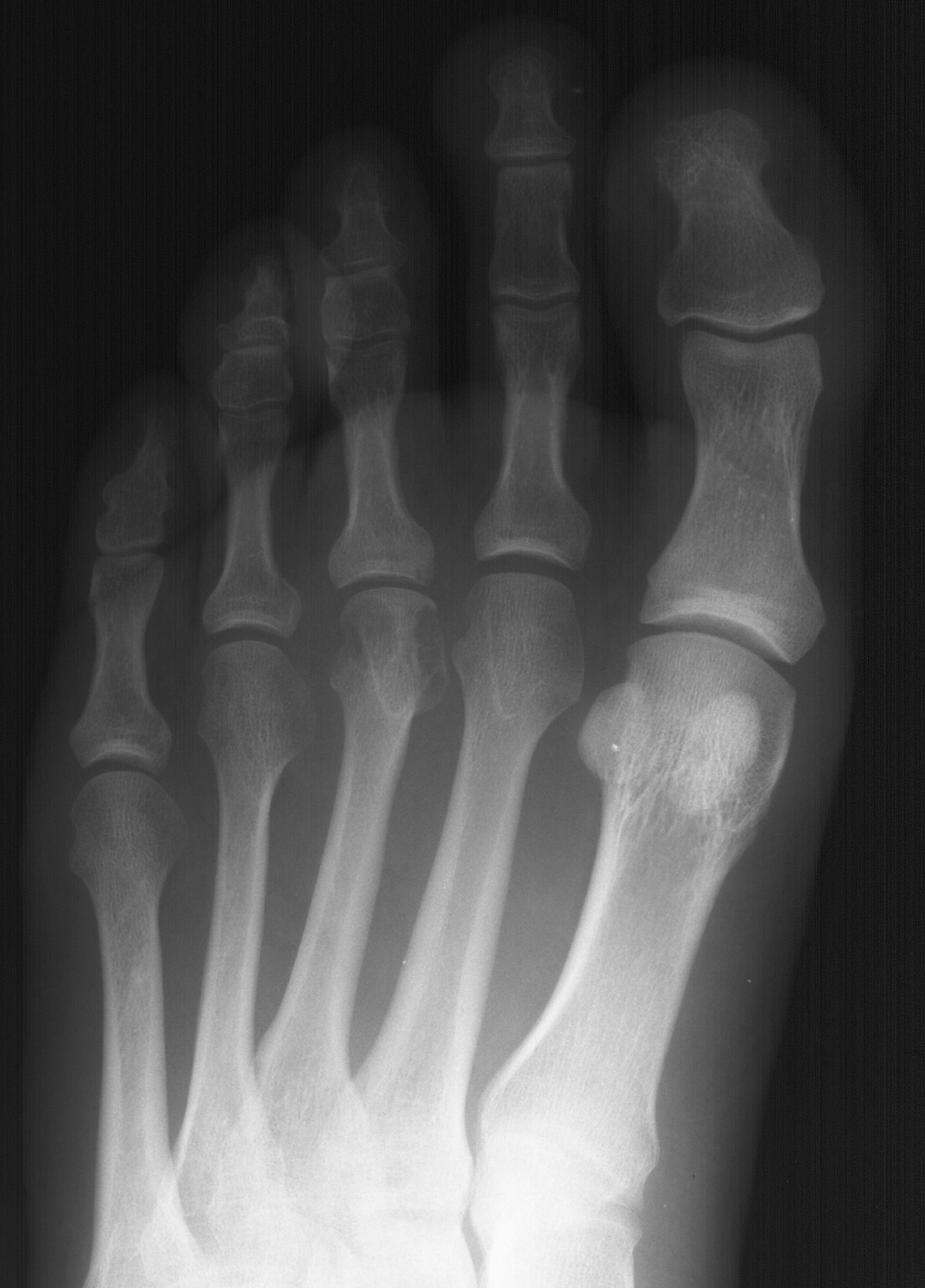 1. DP foot
