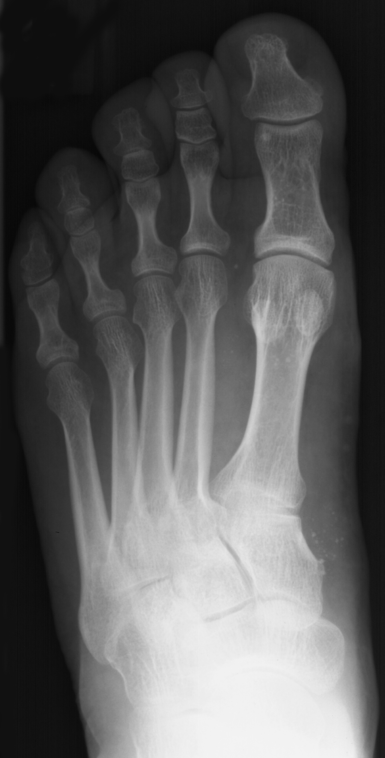 1. DP foot