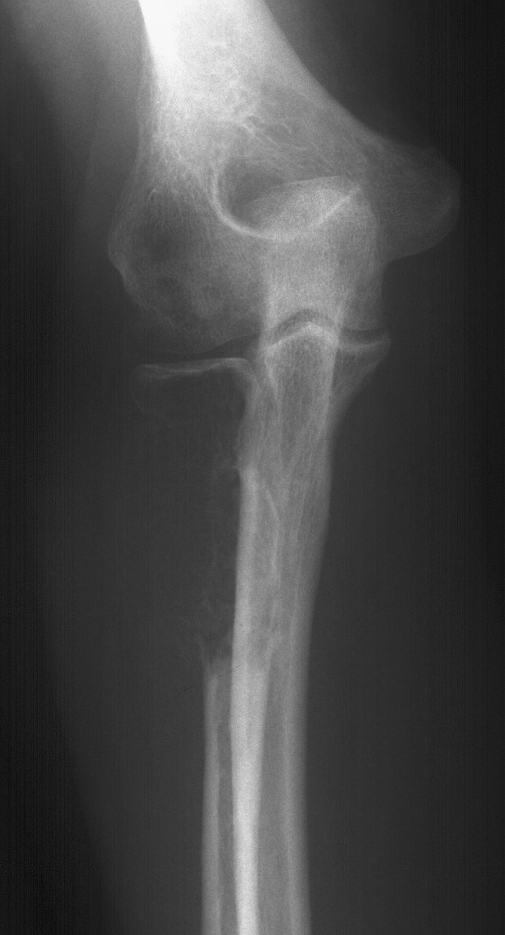 1. AP elbow
