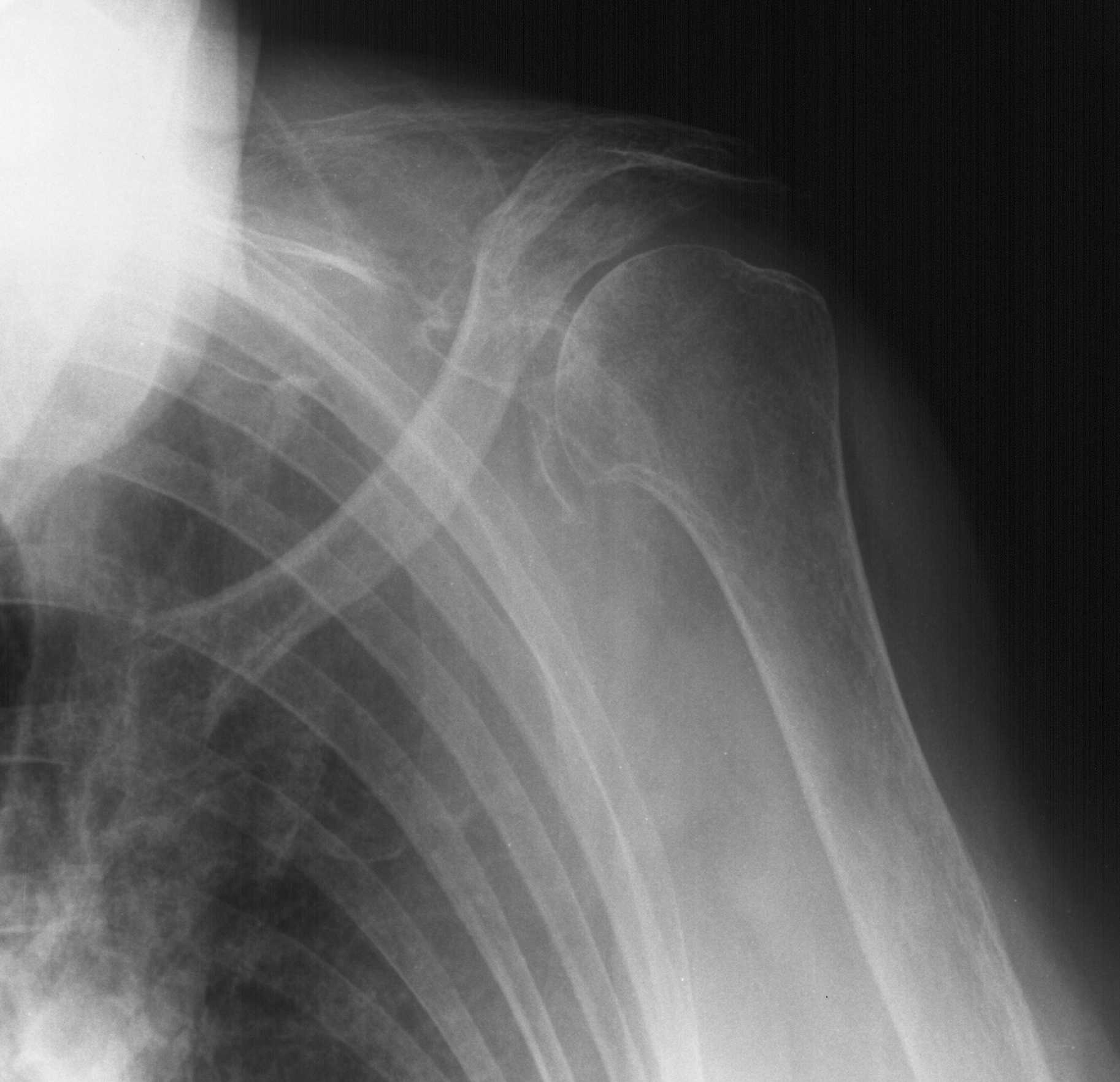 1. AP shoulder