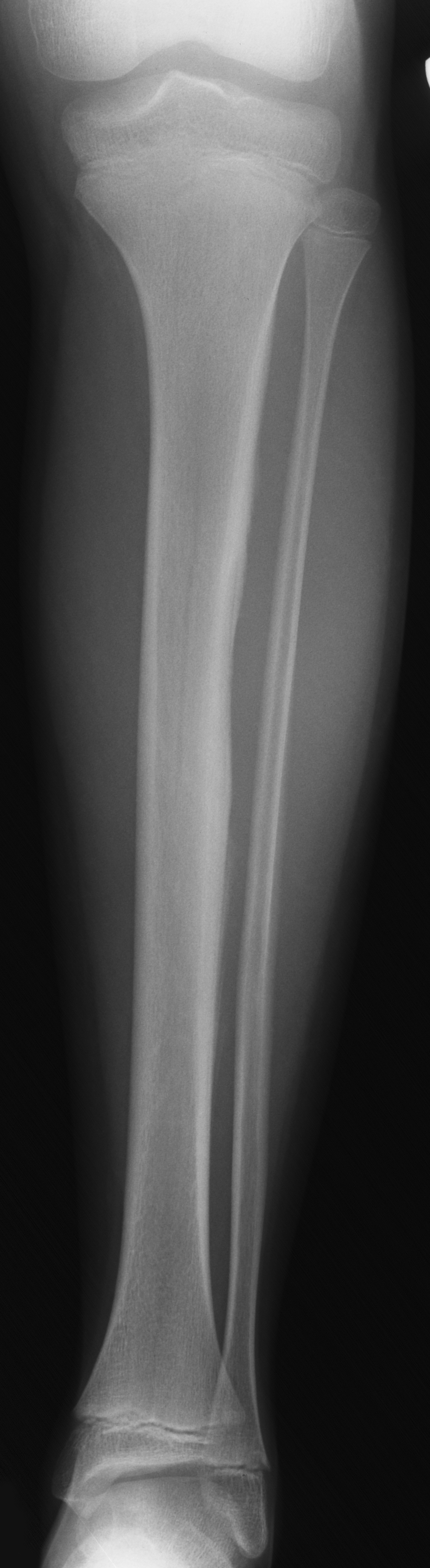 1. AP tibia