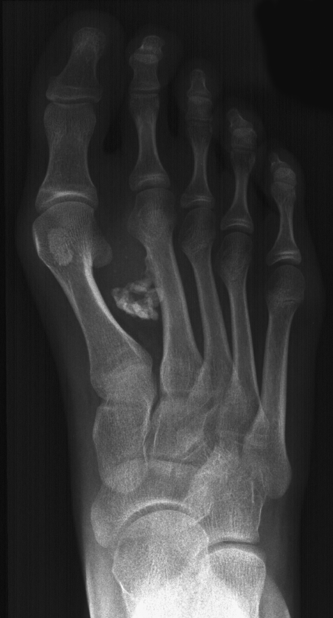 1. DP foot