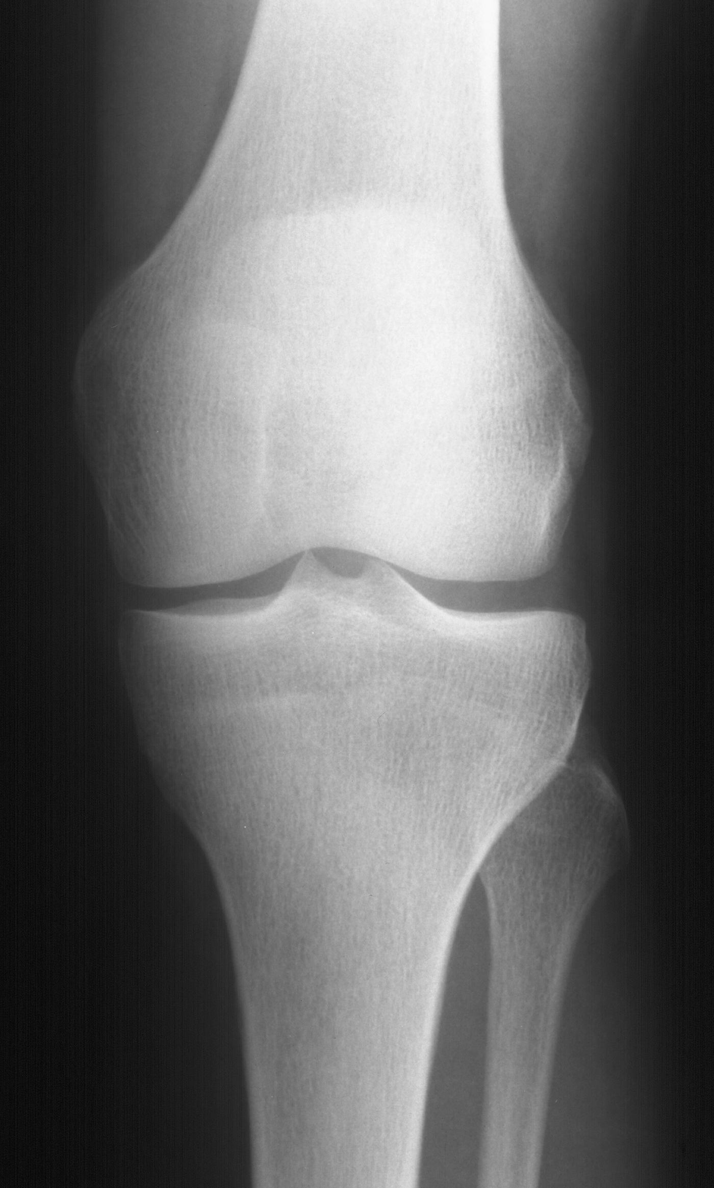 1. AP knee