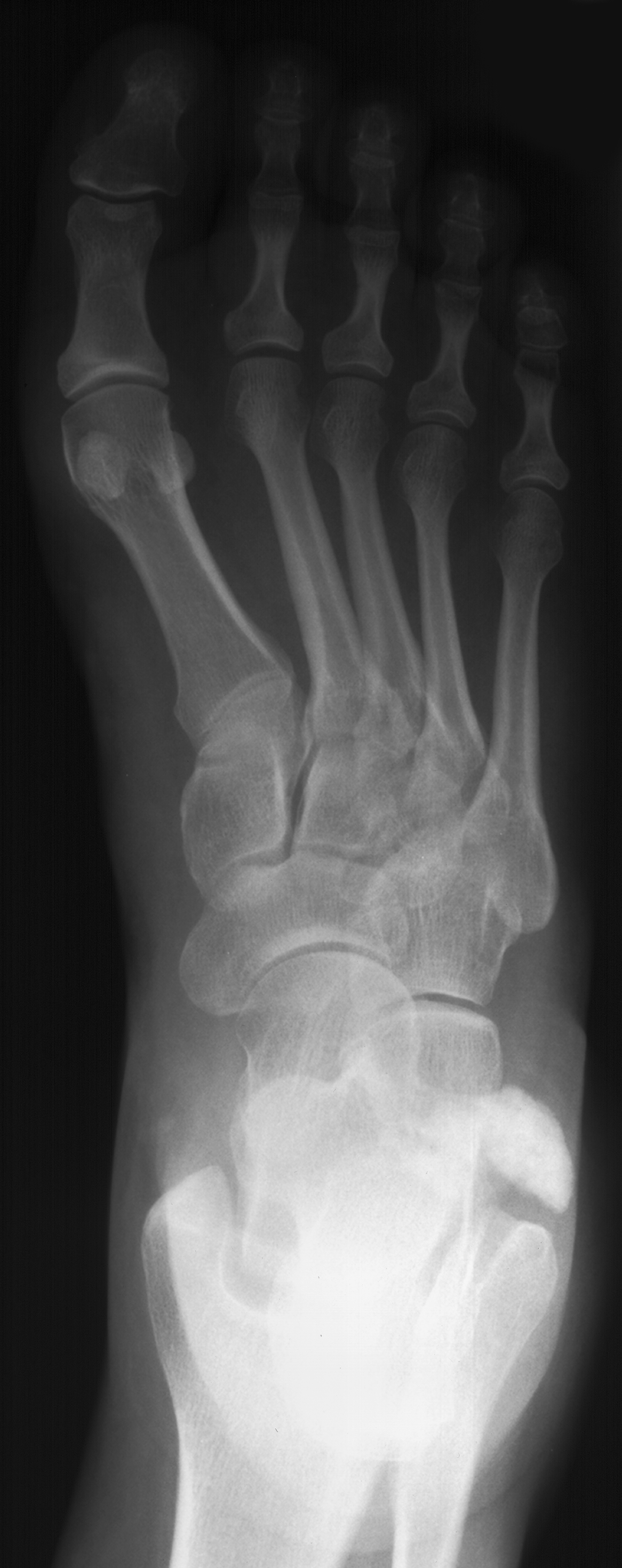1. DP foot