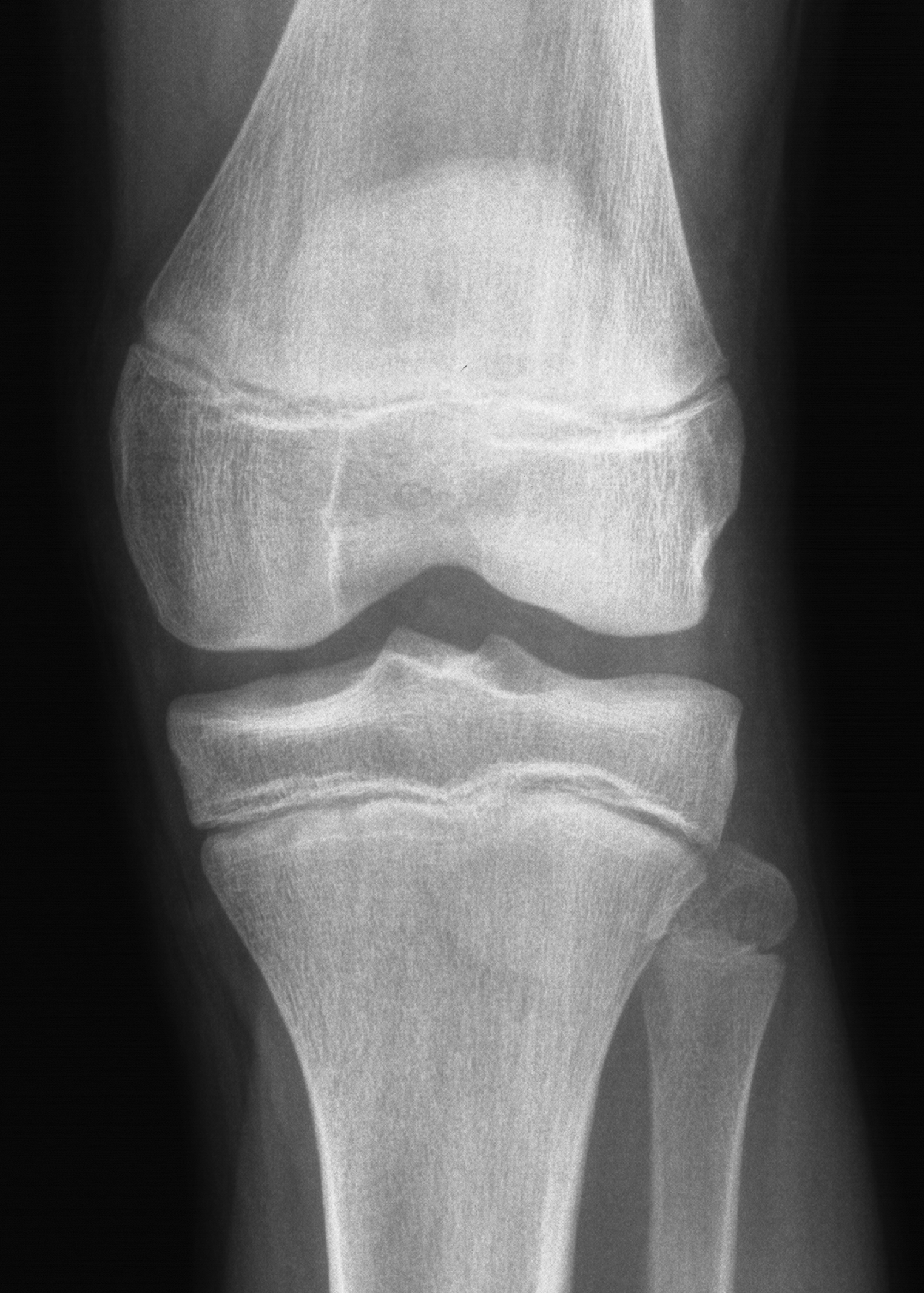 1. AP knee