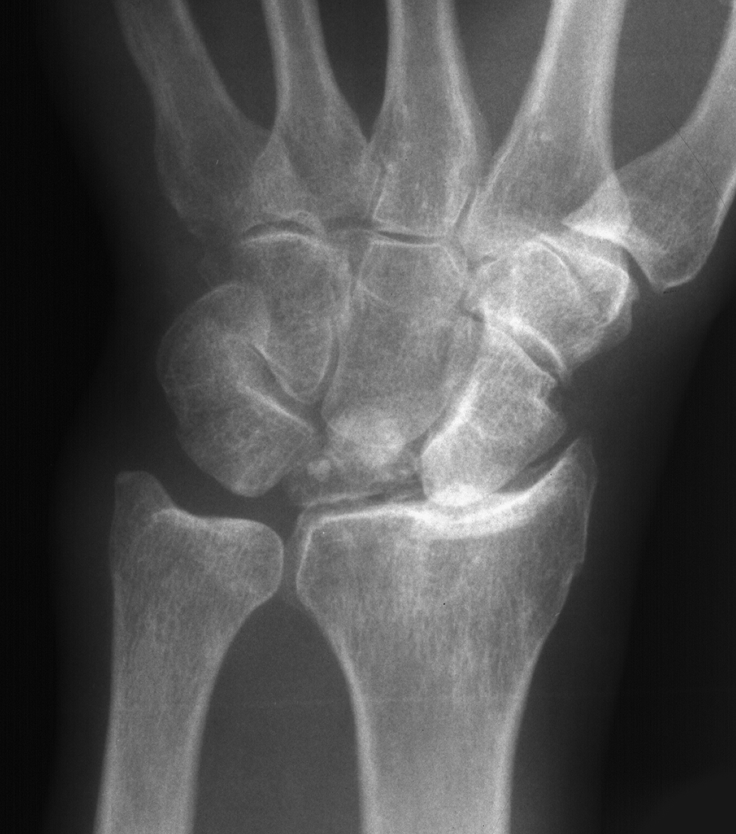 1. PA wrist