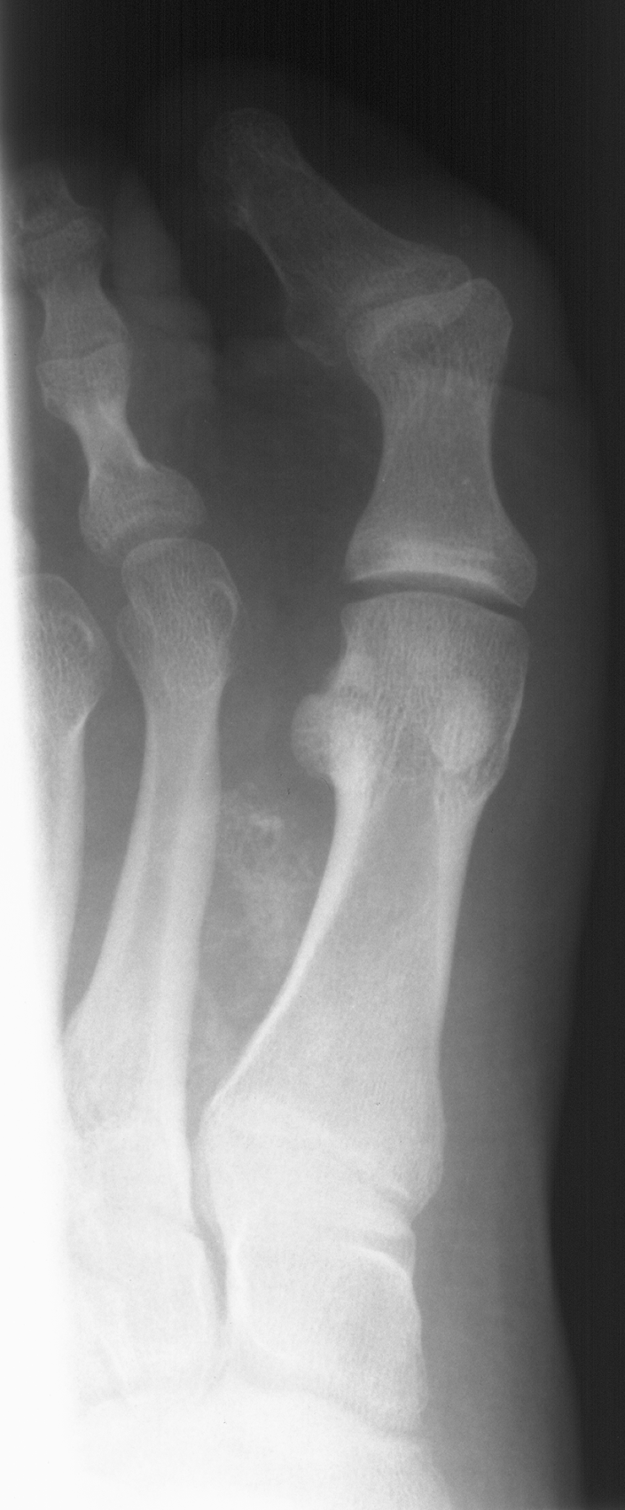 1. DP foot