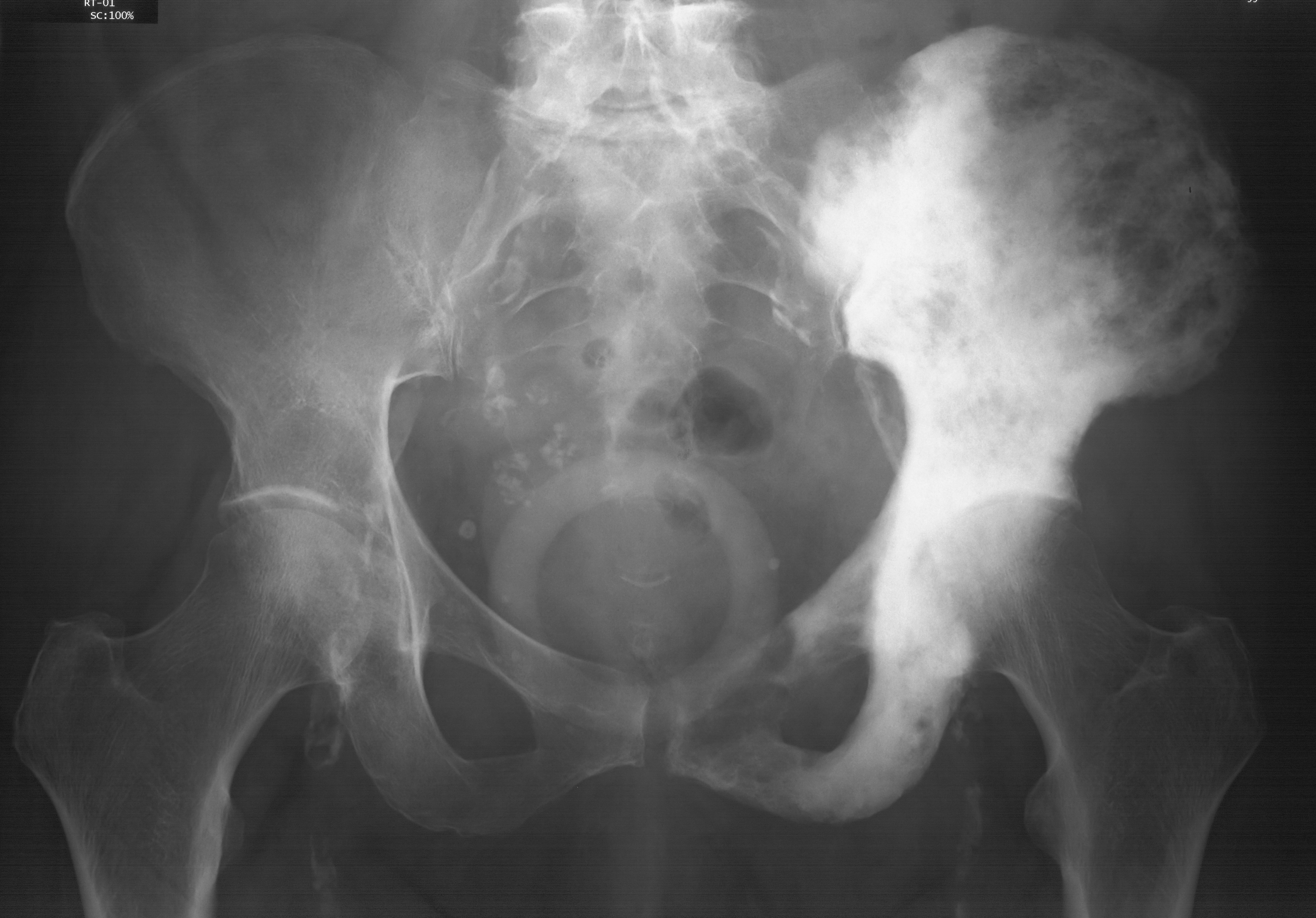 1. AP pelvis