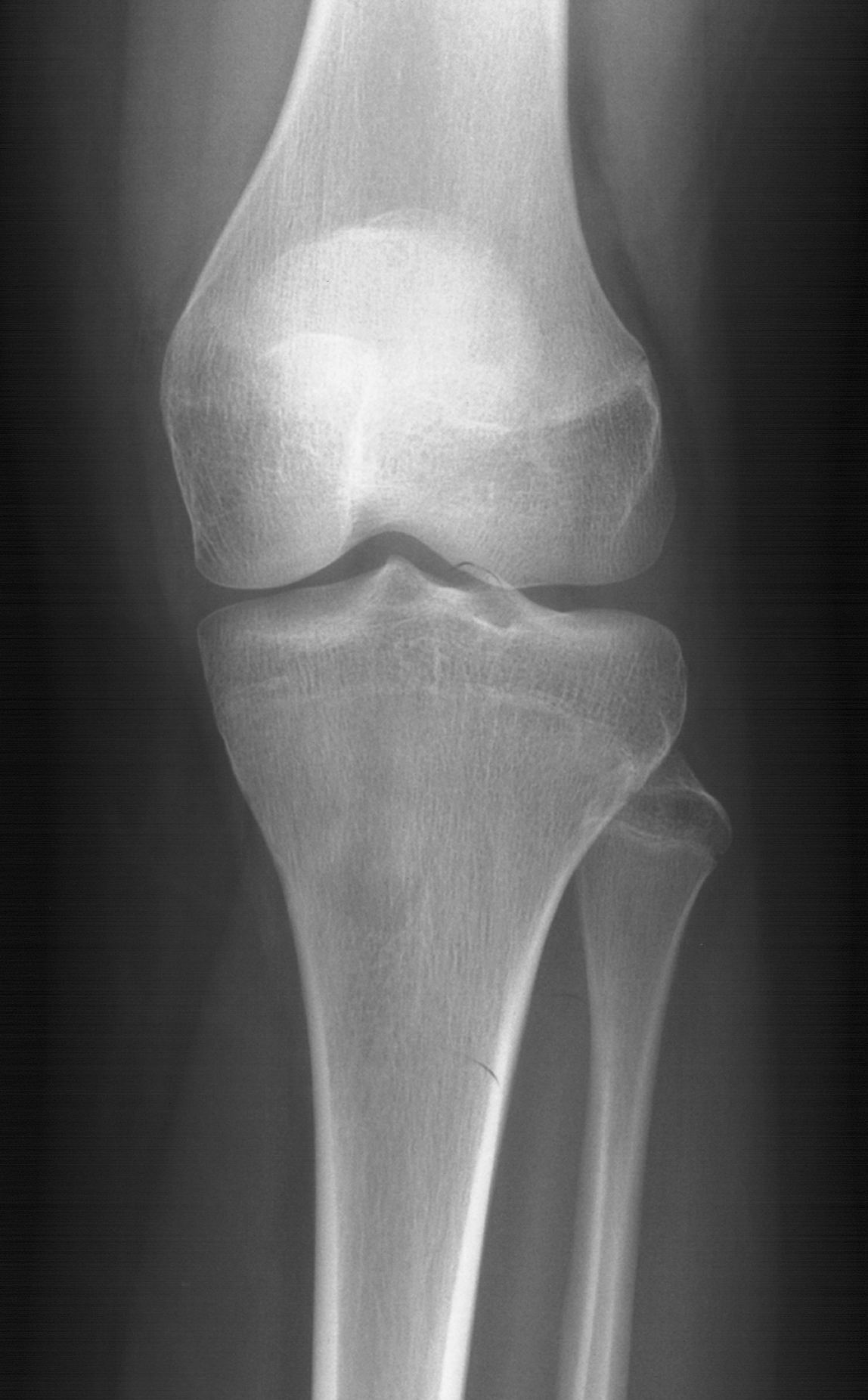 1. PA knee