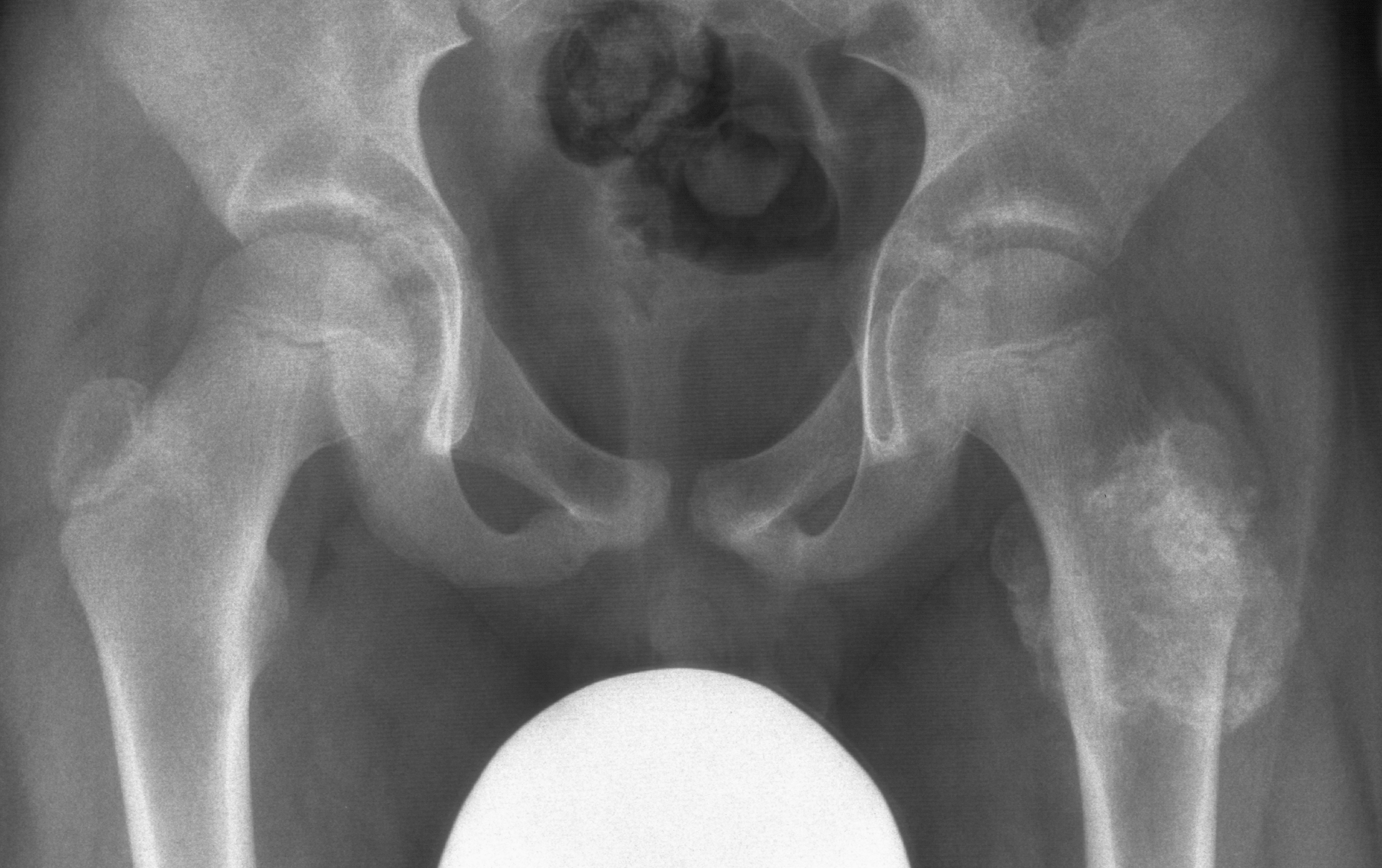 1. AP hips