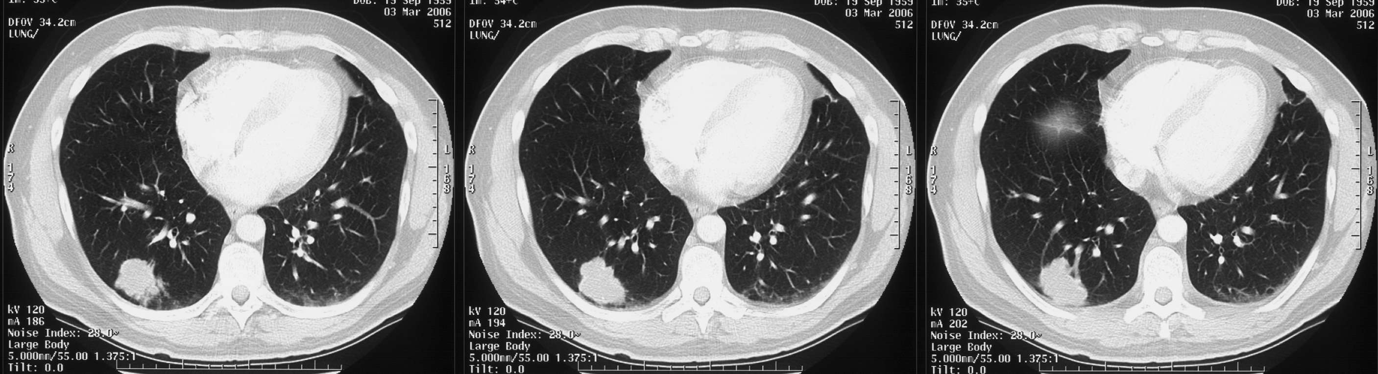 1. CT chest