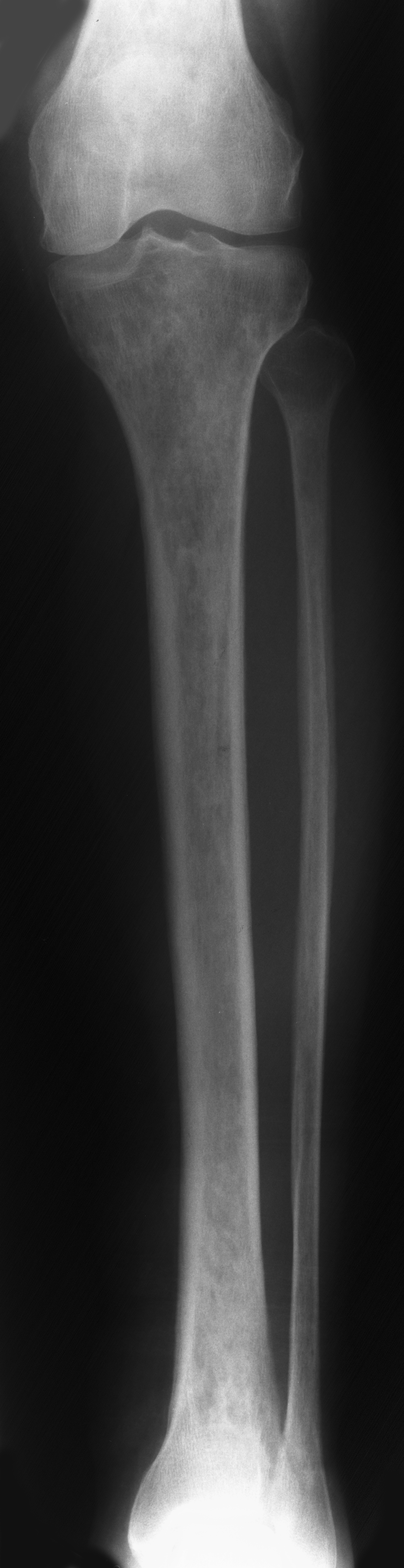 1. AP tibia