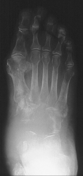 1. DP foot