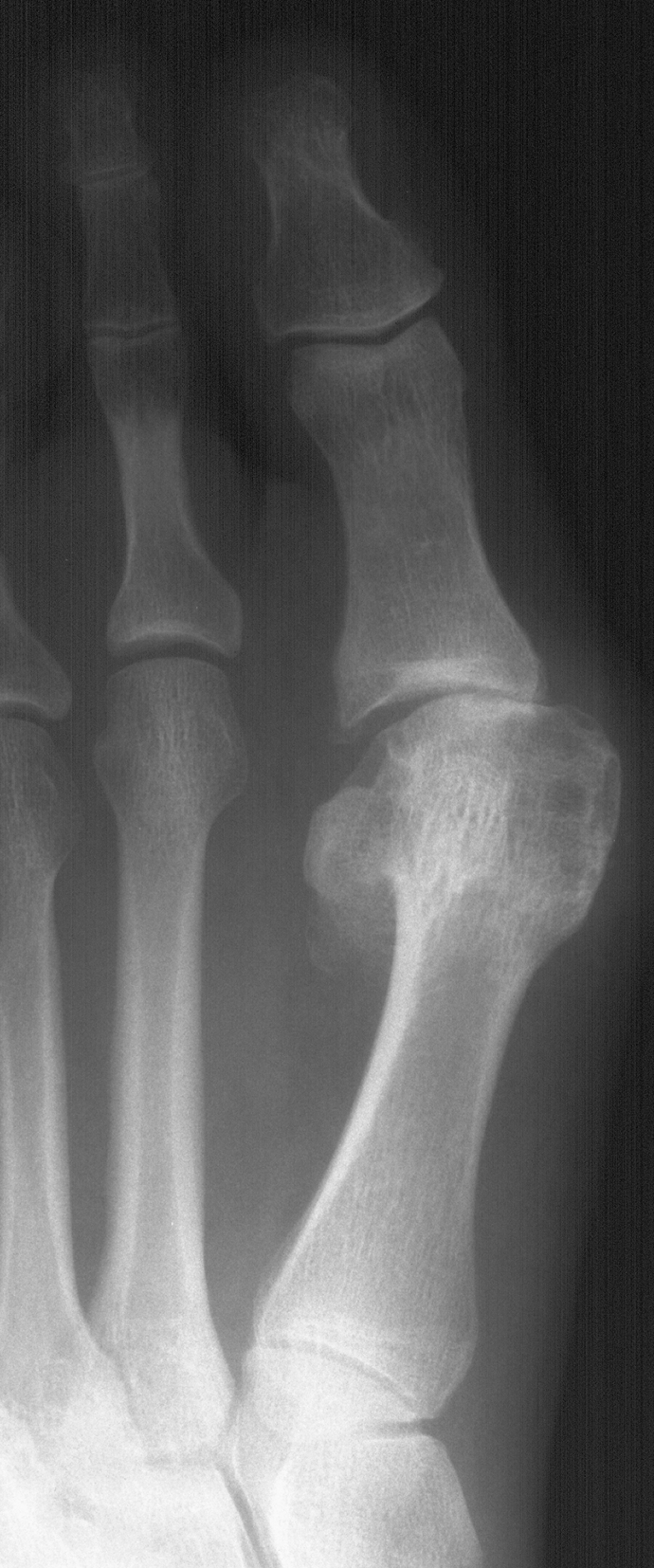 1. DP hallux - preop