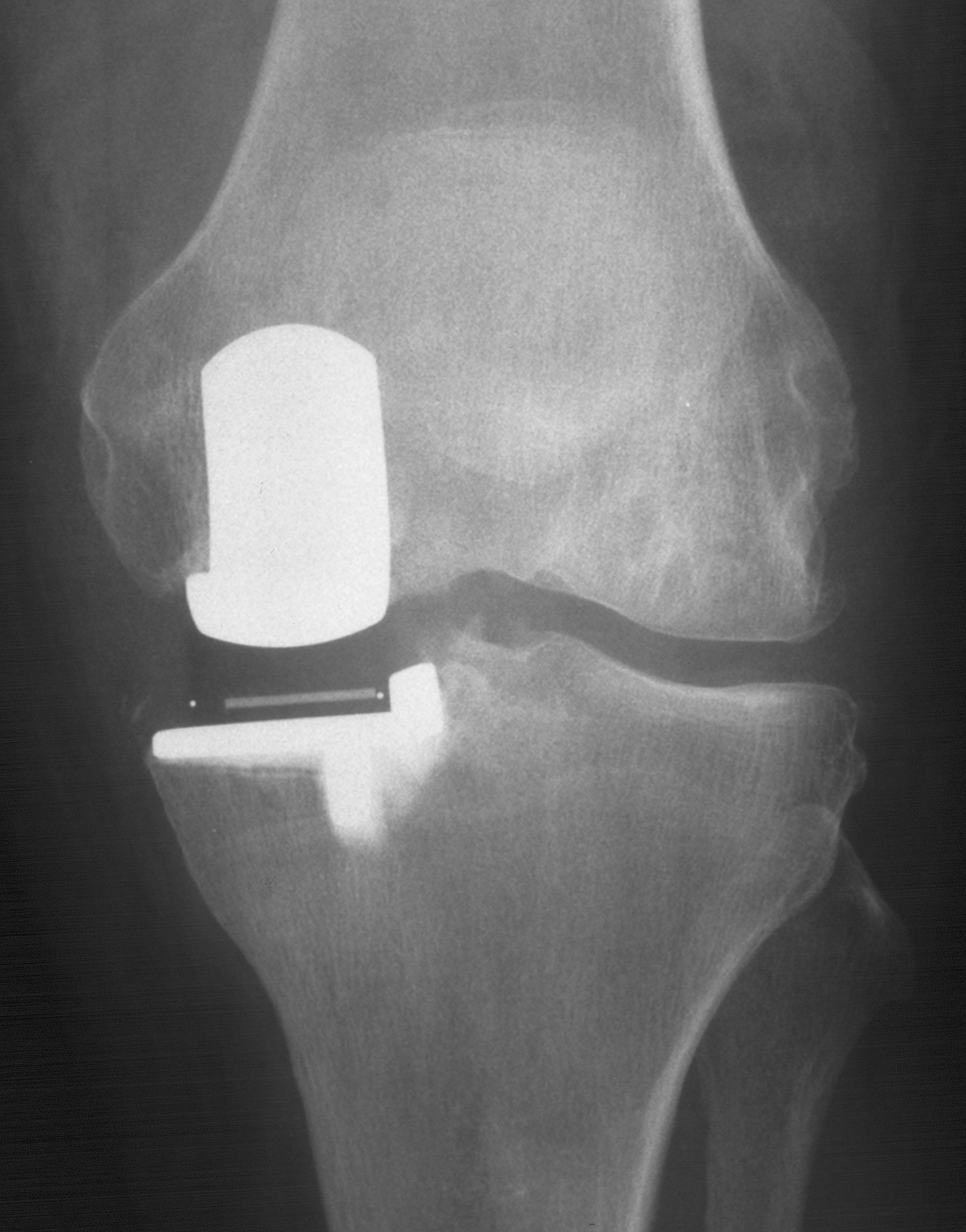 1. AP knee
