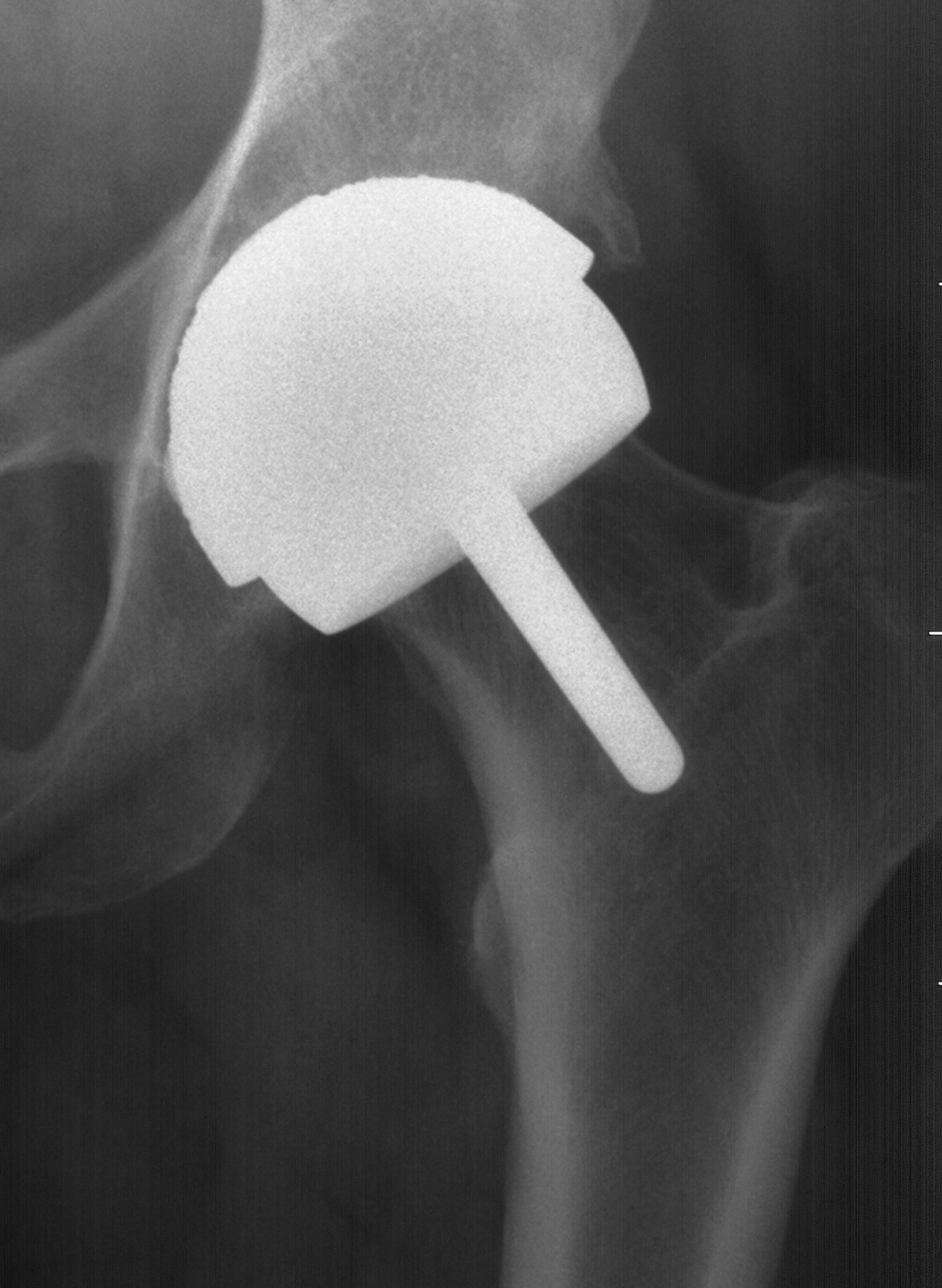 1. AP hip